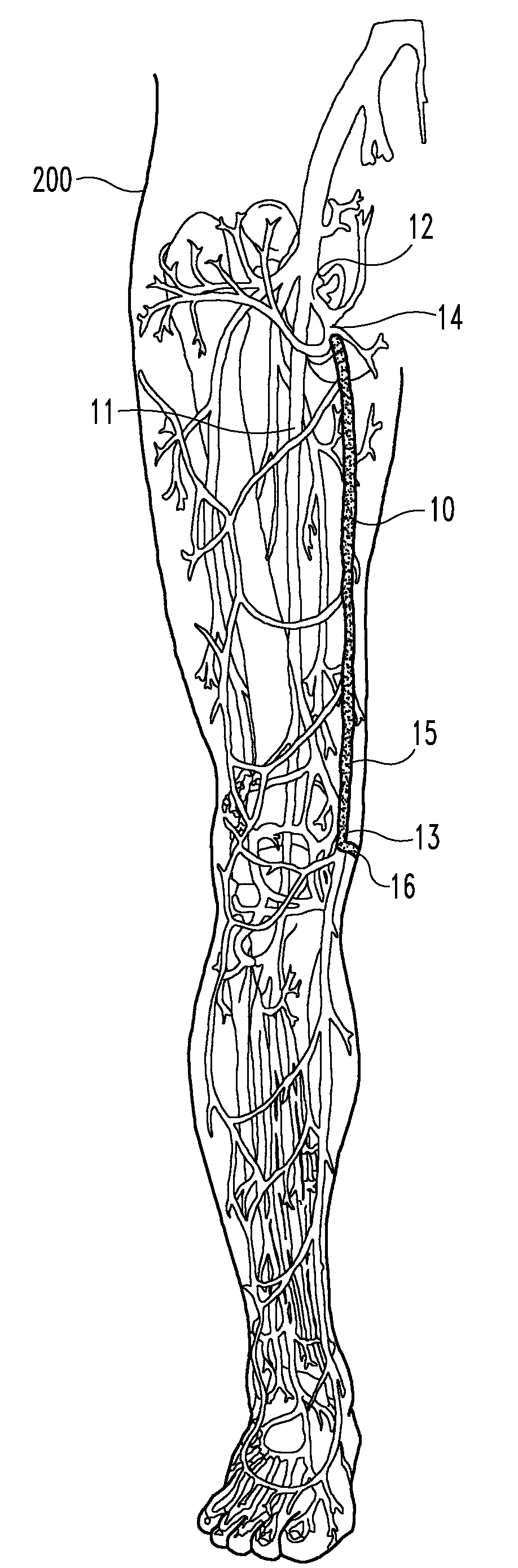 Enhanced remodelable materials for occluding bodily vessels and related methods and systems
