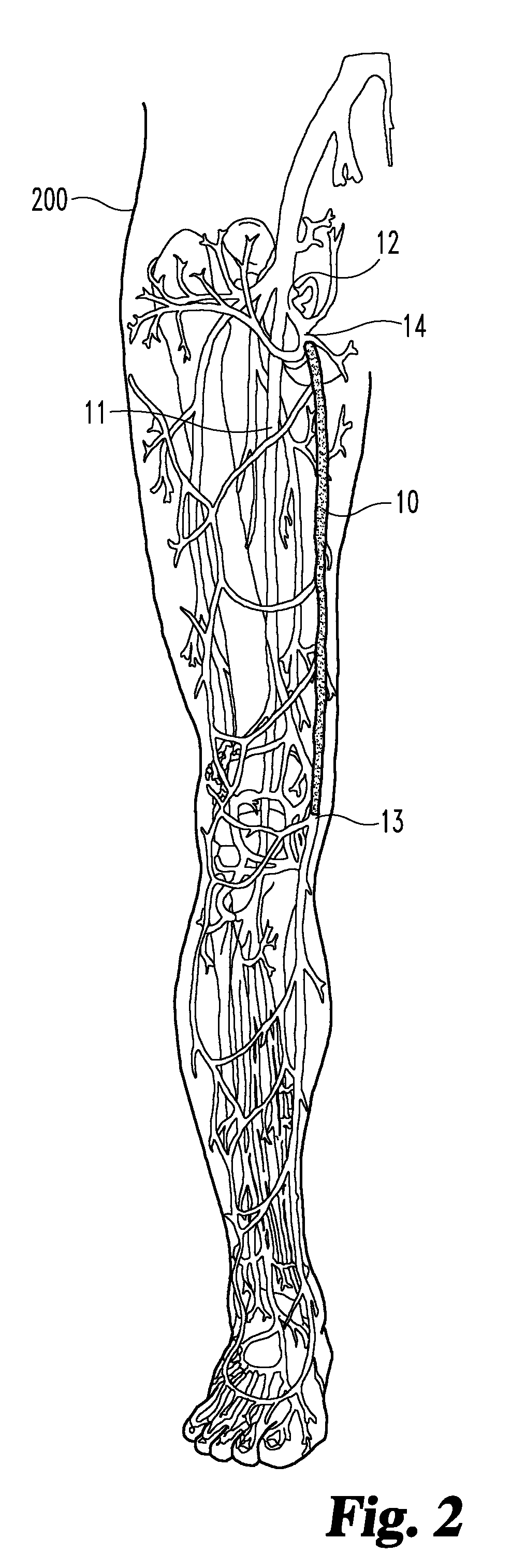 Enhanced remodelable materials for occluding bodily vessels and related methods and systems