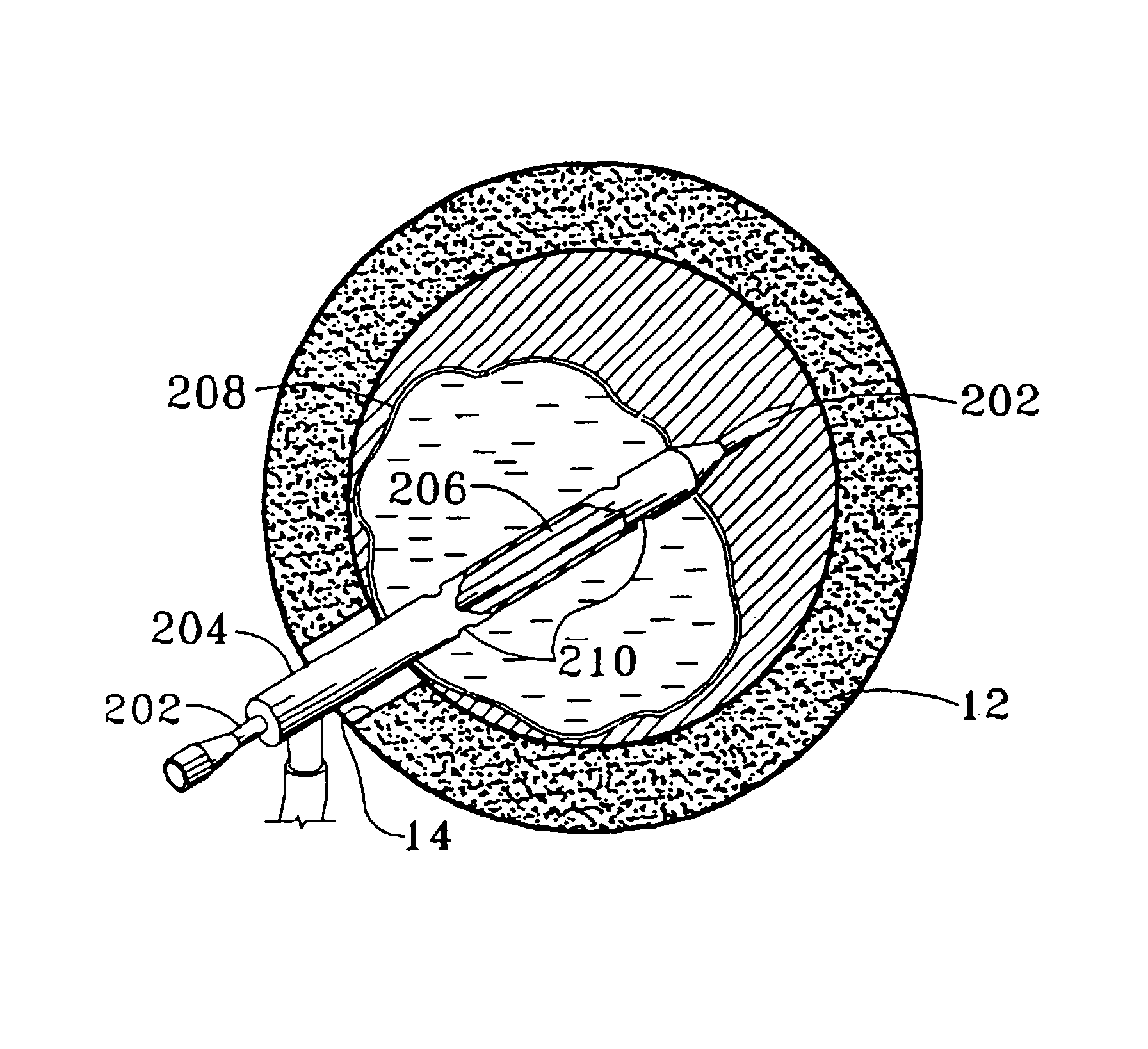 Method and apparatus for treating intervertebral disks