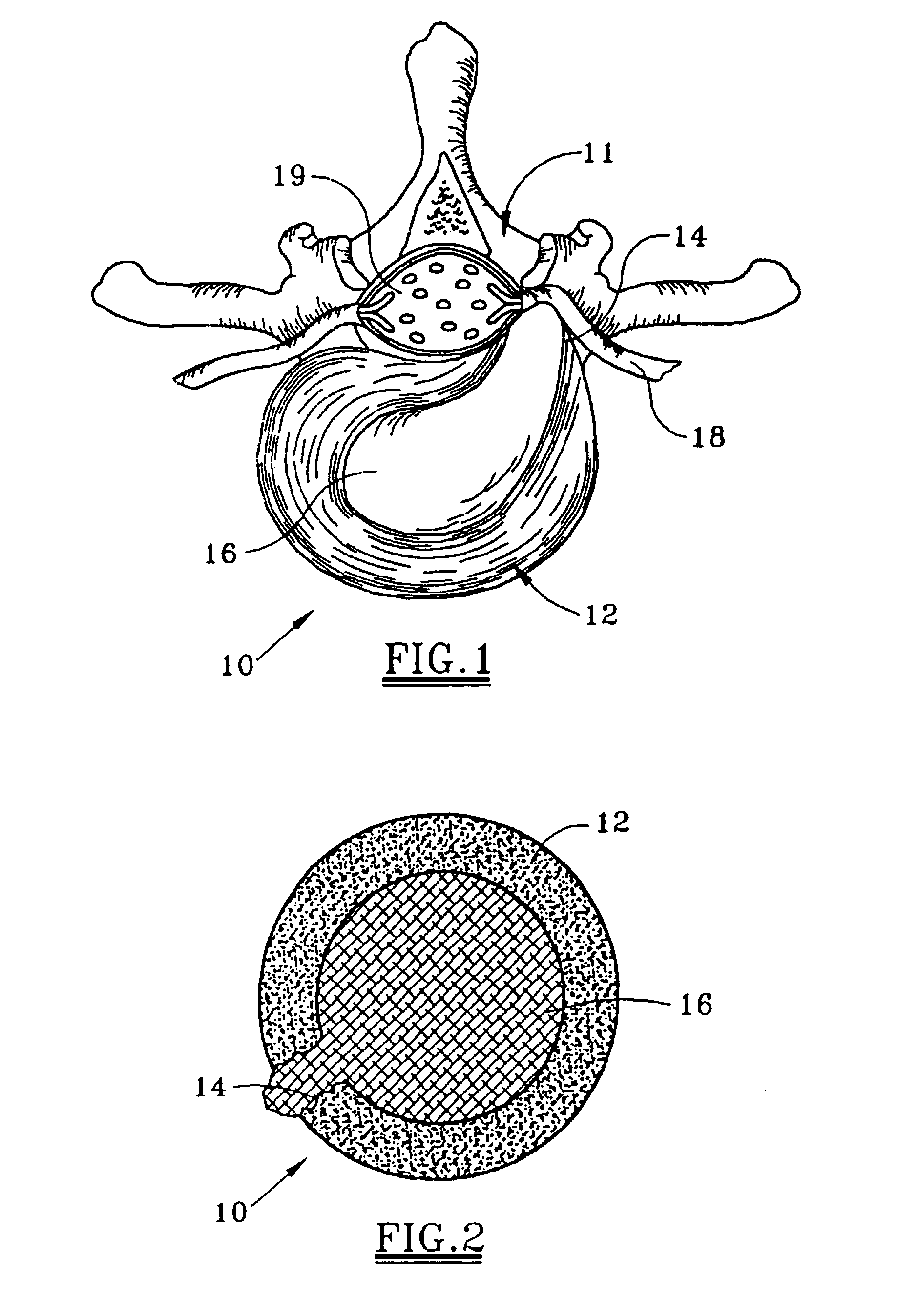 Method and apparatus for treating intervertebral disks