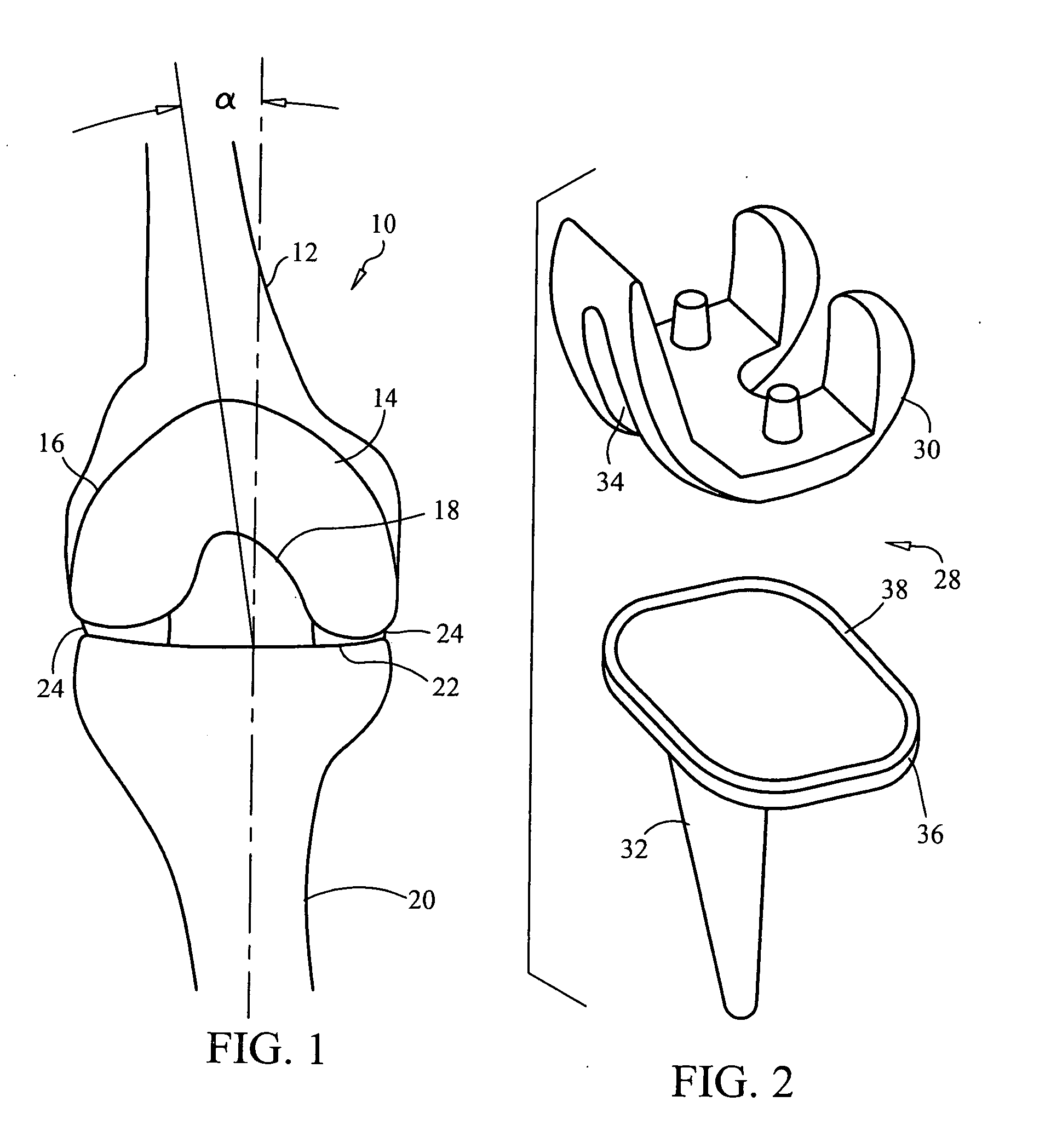 Gender specific implant and packaging