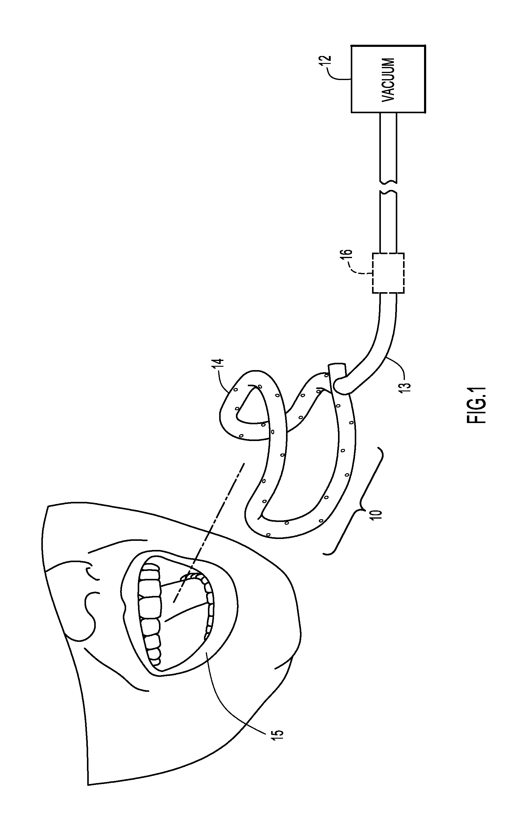 Dental appliance and method for removing bodily and other fluids from a dental site