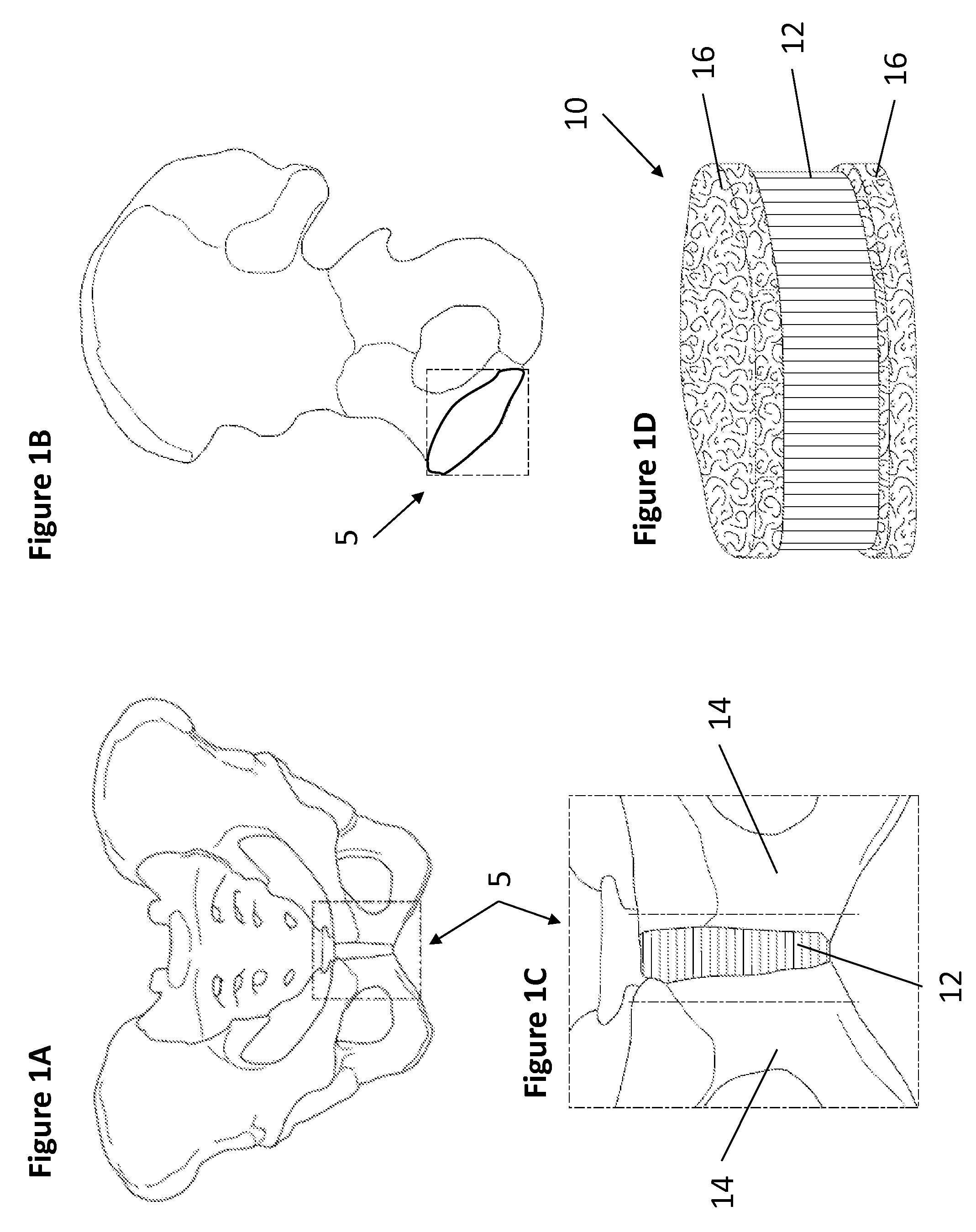 Biological Disc Graft and Method for Relief of Lower Back Pain and Joint Pain