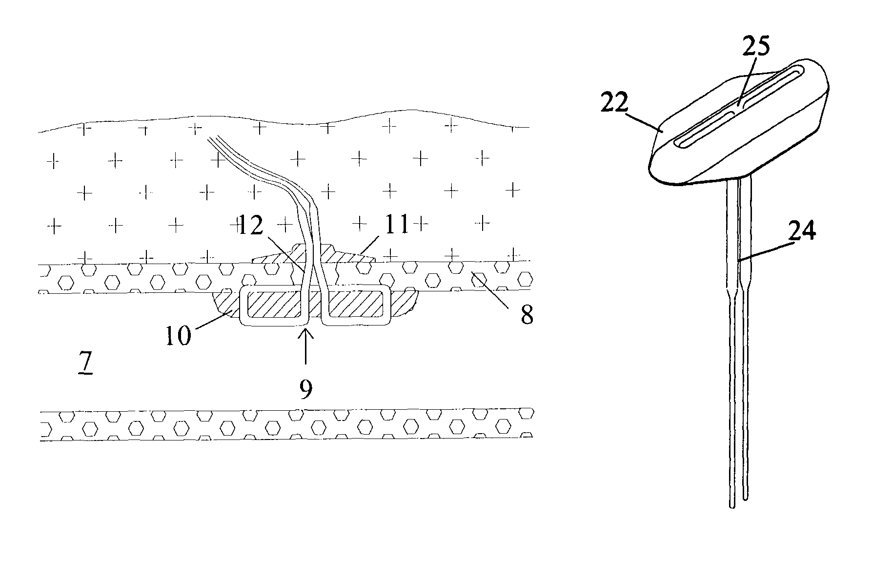 Absorbable medical sealing device with retaining assembly having at least two loops