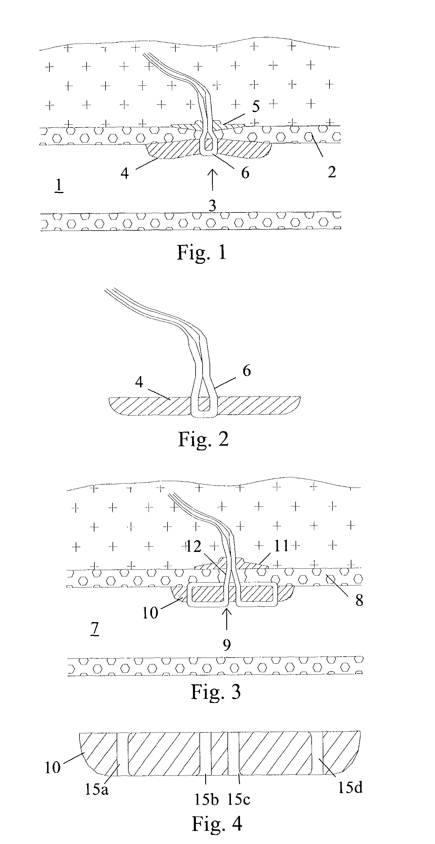 Absorbable medical sealing device with retaining assembly having at least two loops