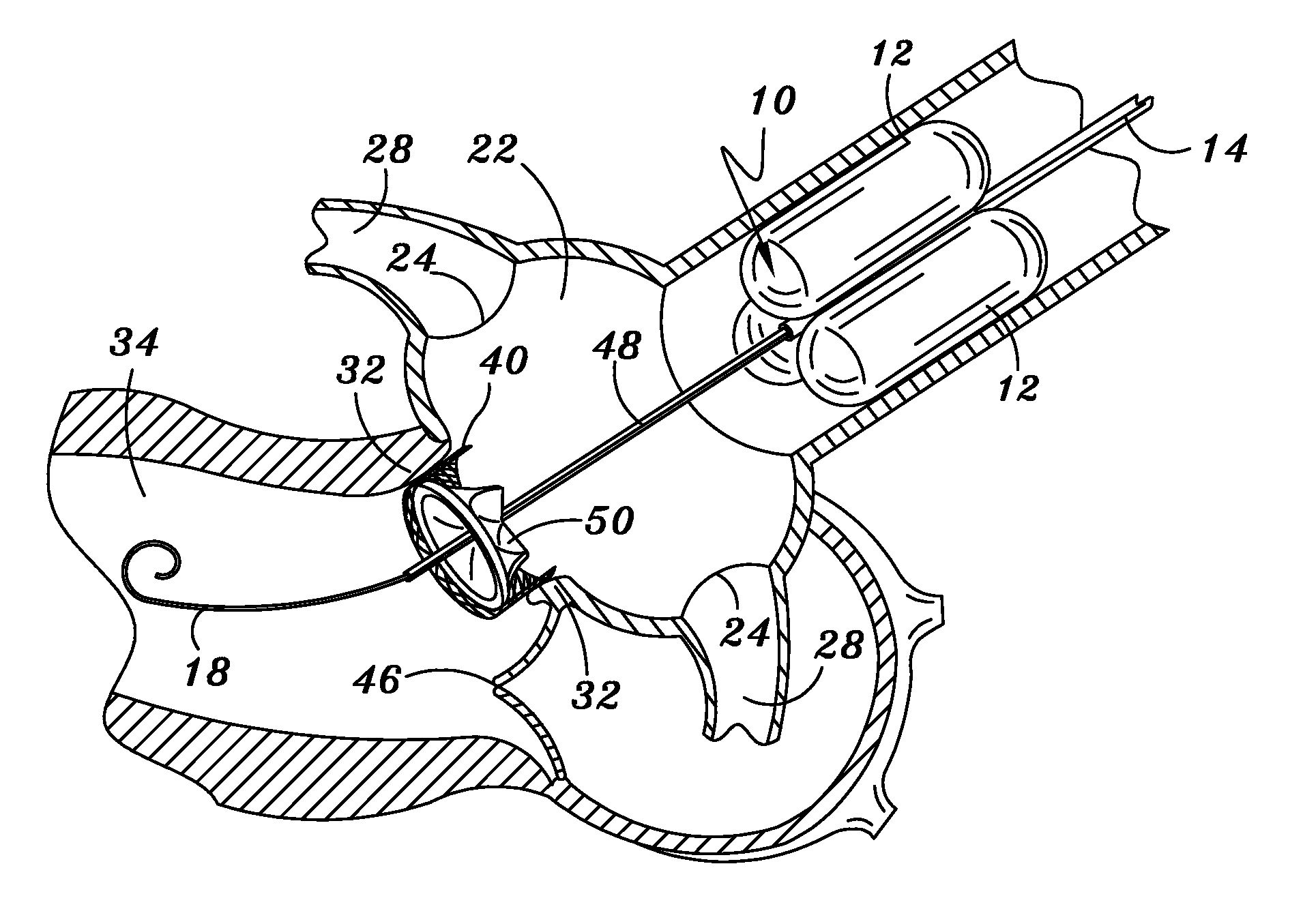Method and Apparatus for Percutaneous Aortic Valve Replacement