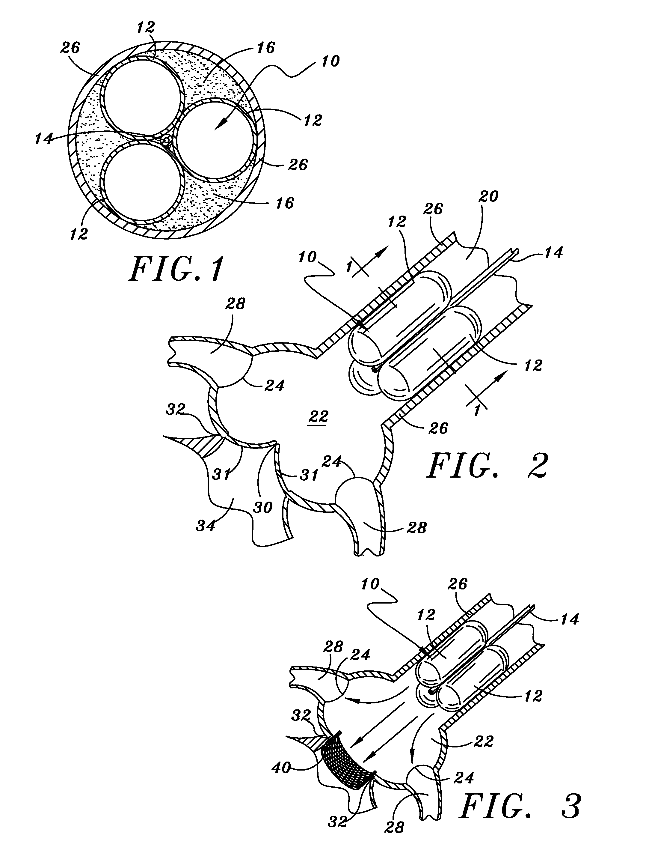 Method and Apparatus for Percutaneous Aortic Valve Replacement