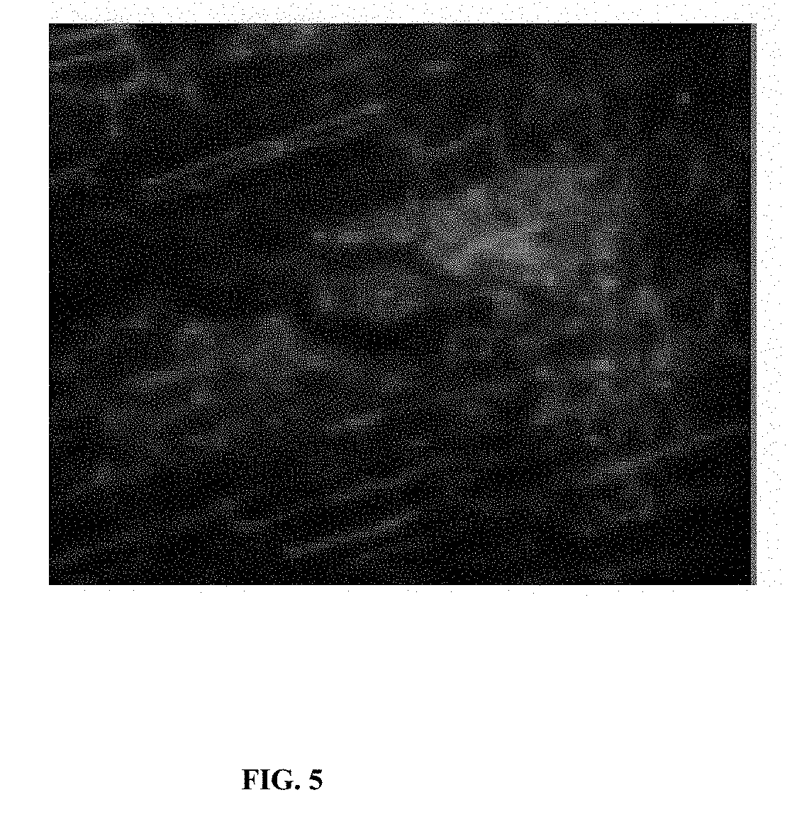 Methods for Quantitative Analysis and Targeting of Inflammatory Breast Cancer Tumor Emboli