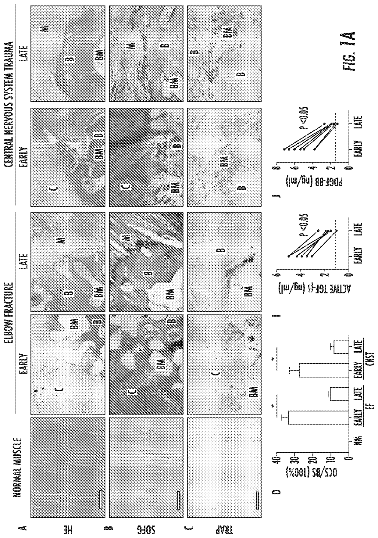 Heterotopic ossification and method of treatment