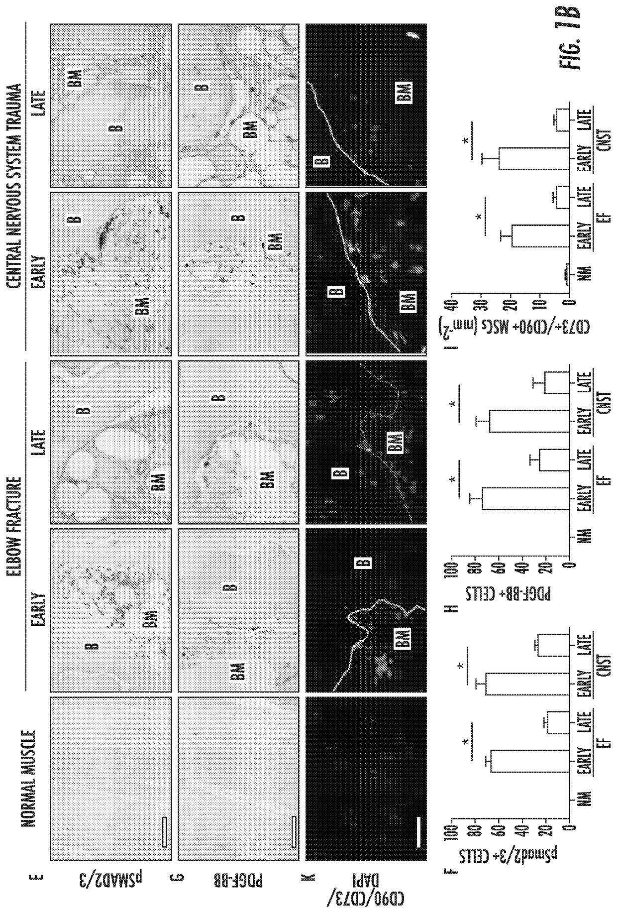 Heterotopic ossification and method of treatment