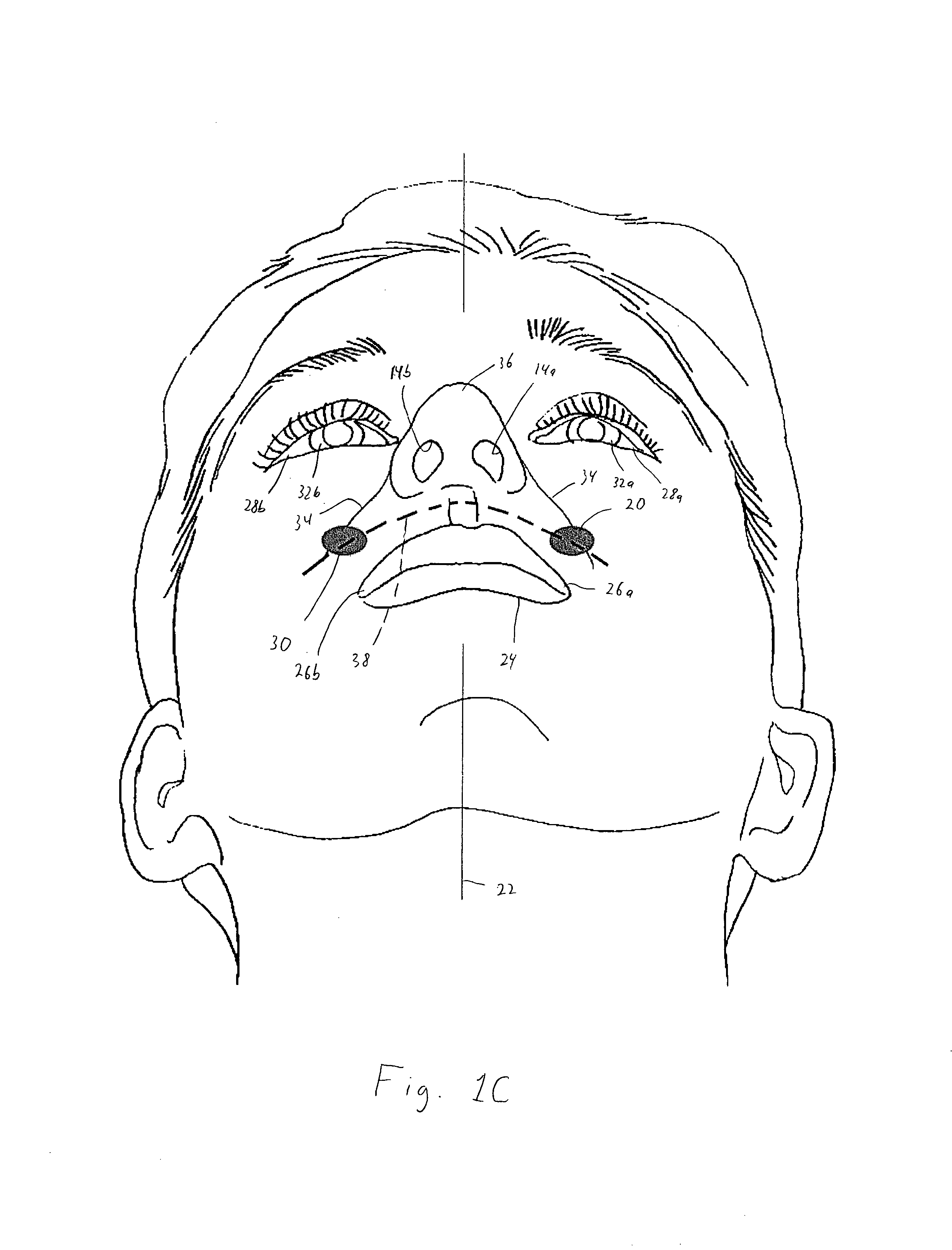 Patient interface device with limited support area on the face