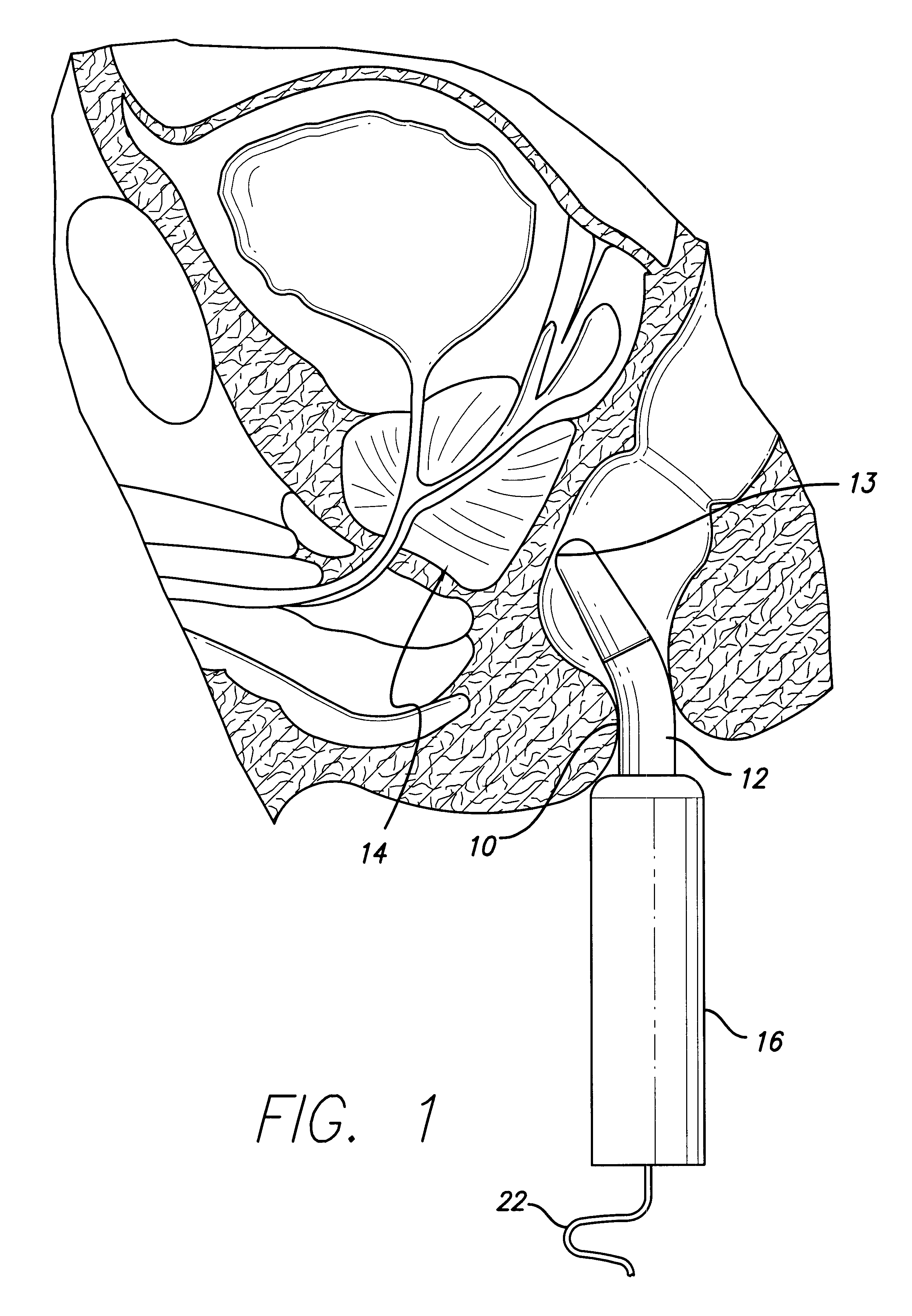 Ultrasound system for disease detection and patient treatment
