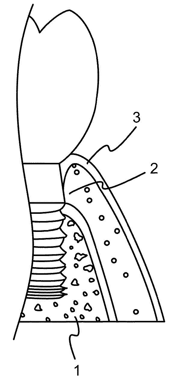 Implant Surface Treatment Method Having Tissues Integrated