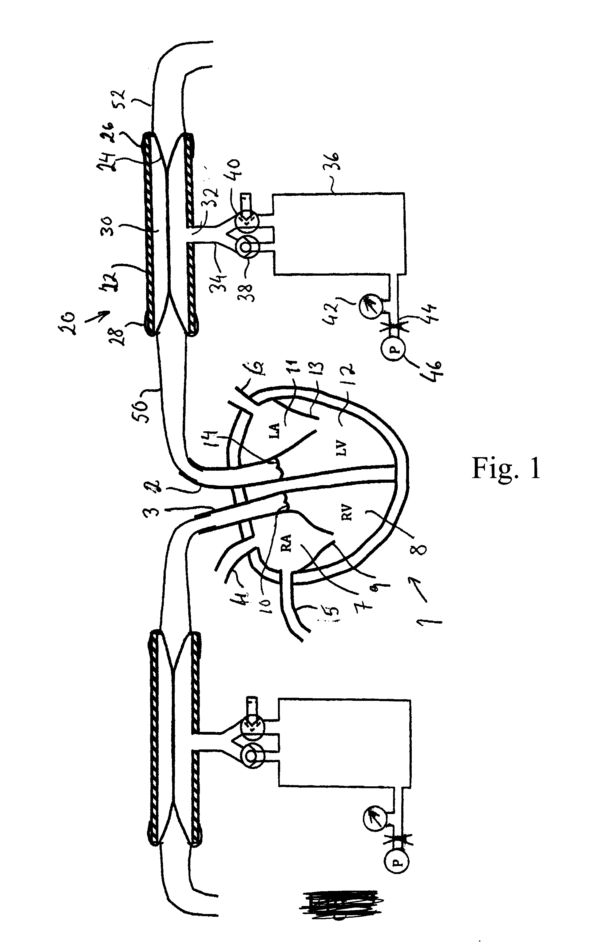 An afterload device for a beating heart during examination thereof