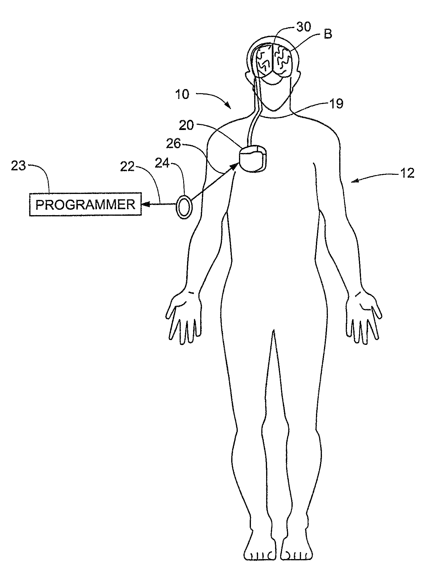 Method and apparatus for the treatment of movement disorders