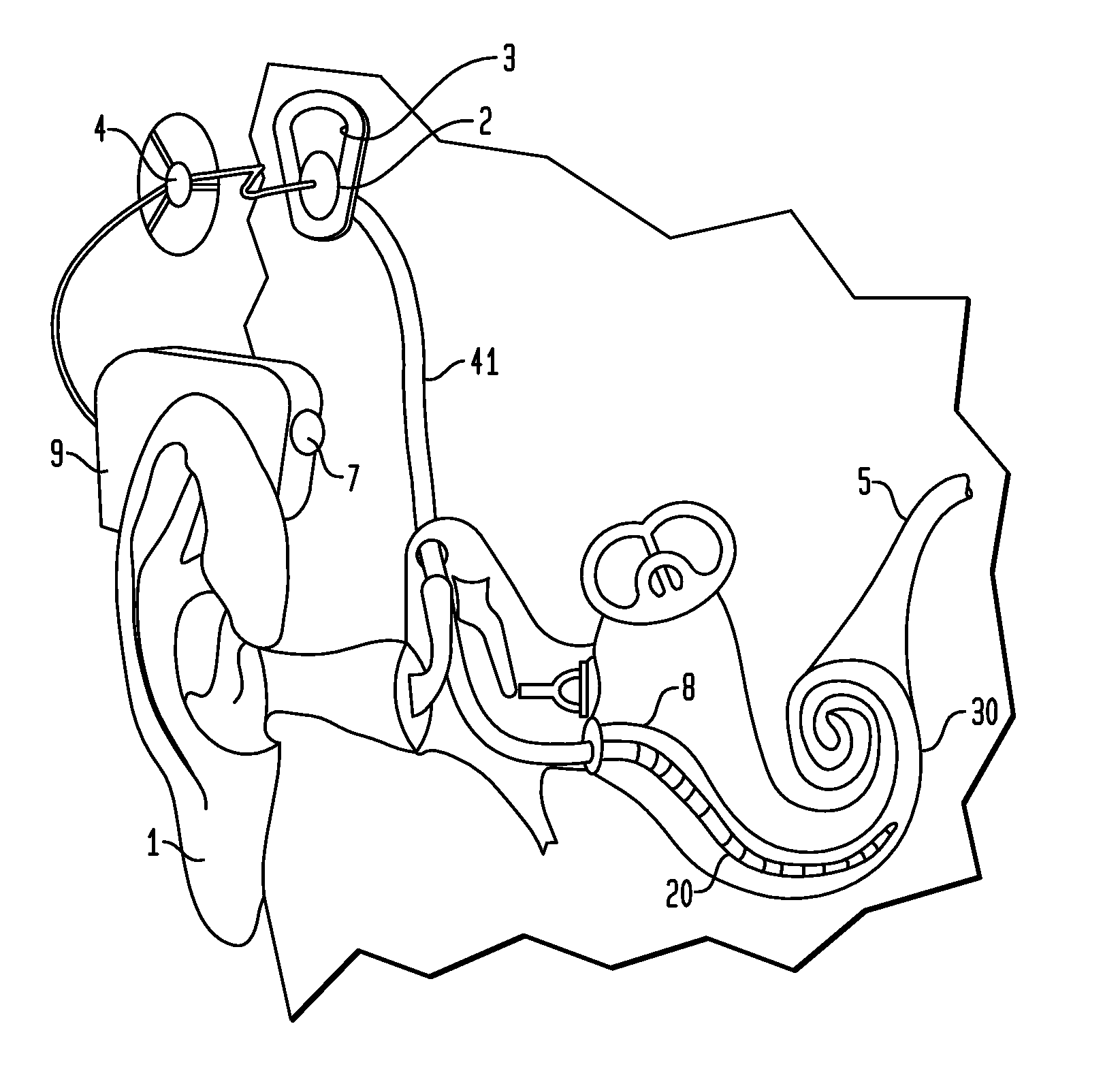 Apparatus for delivery of pharmaceuticals to the cochlea
