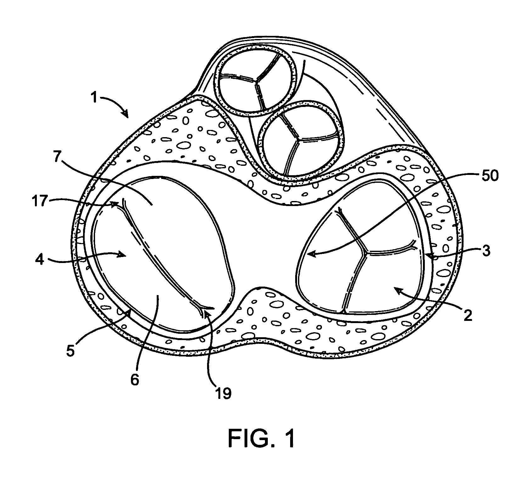 Device, system, and method for treating cardiac valve regurgitation