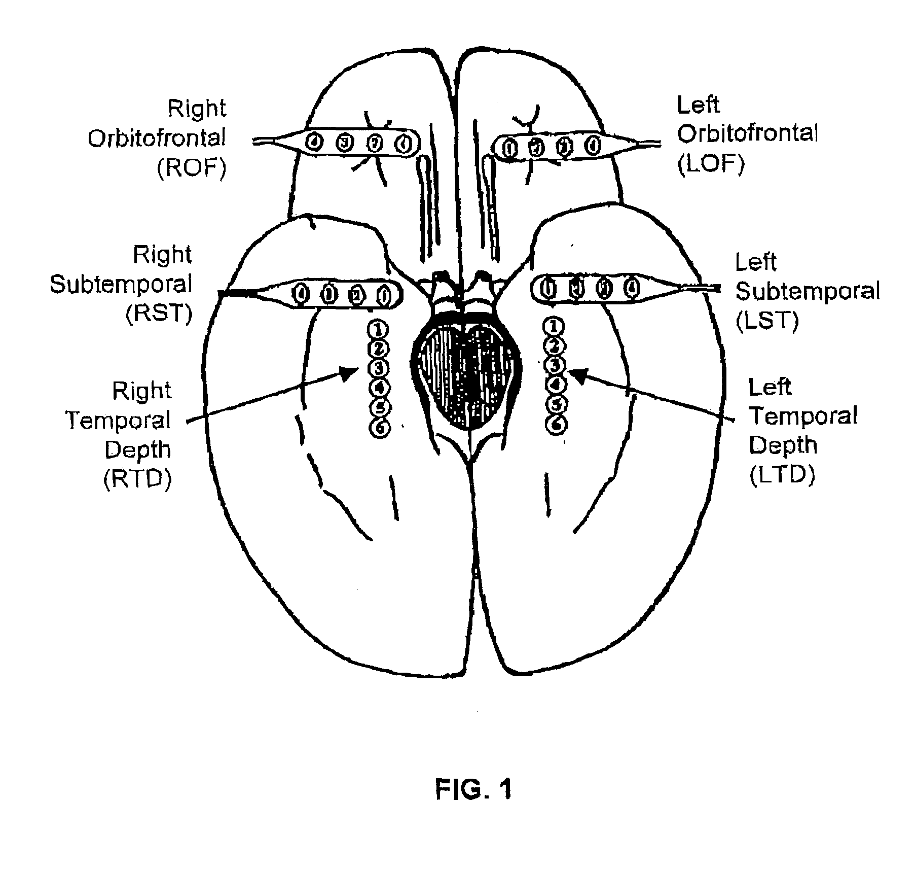 Methods for applying brain synchronization to epilepsy and other dynamical disorders