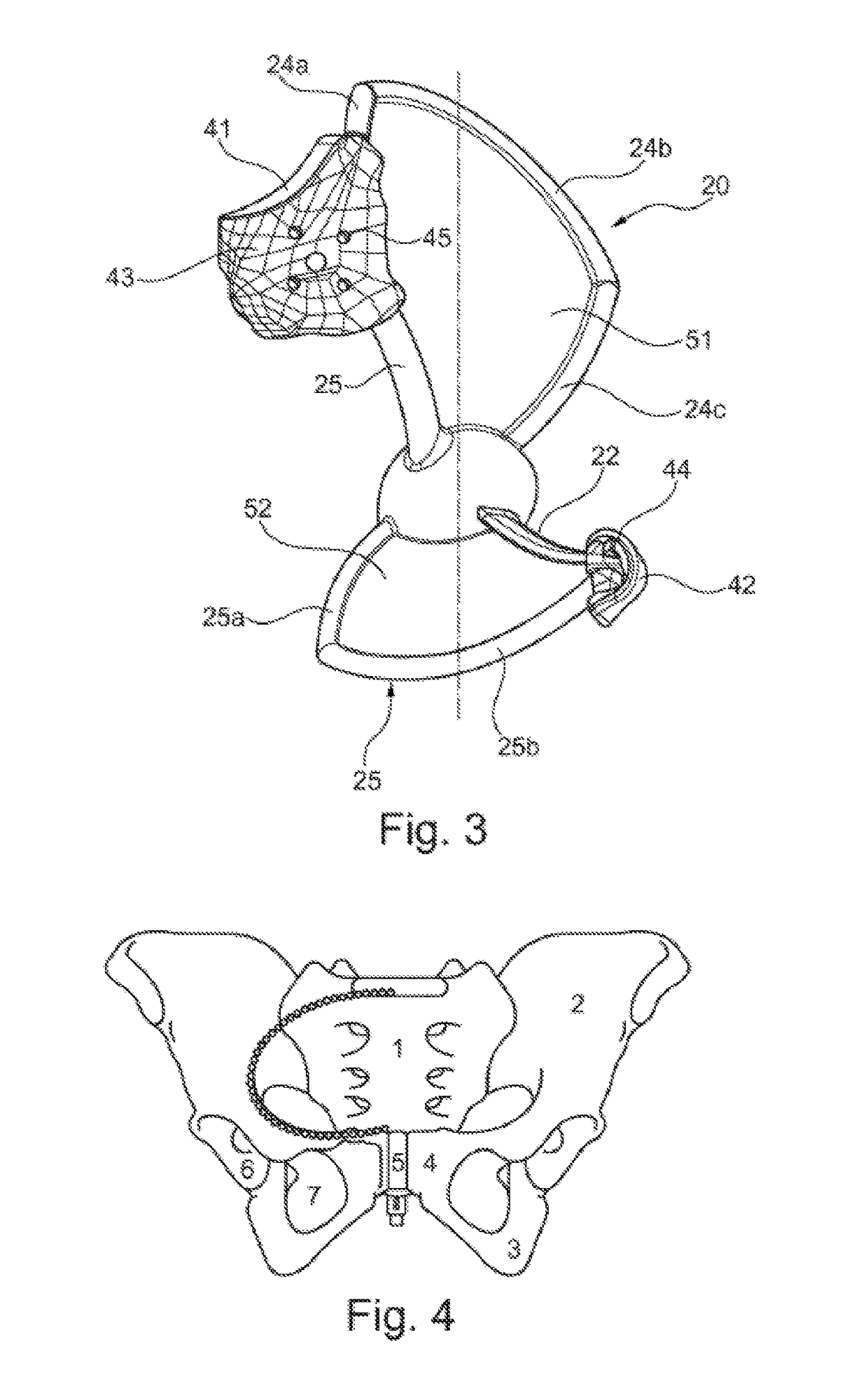 Implant for reconstructing an acetabulum and at least part of a pelvic structure
