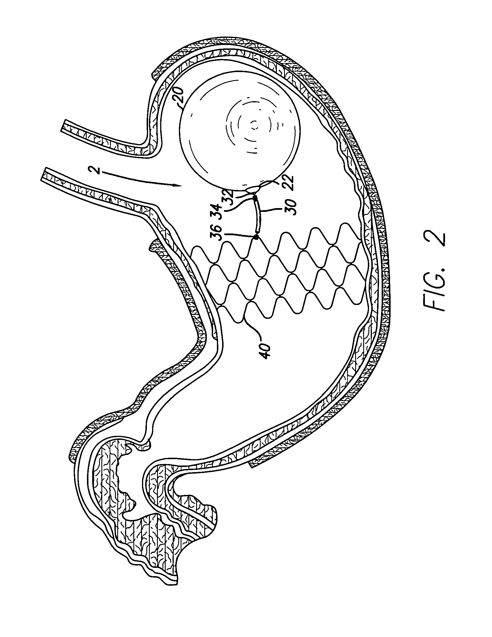 Stented anchoring of gastric space-occupying devices