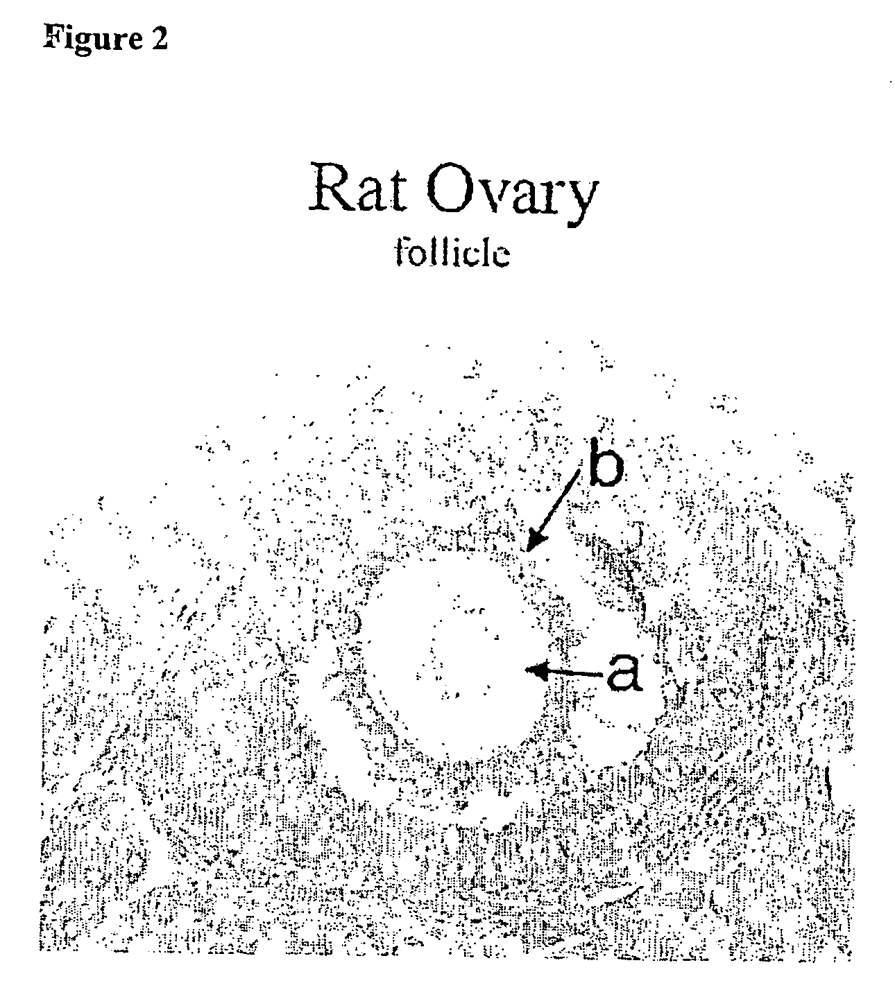 Assay for autoantibodies to folate receptors