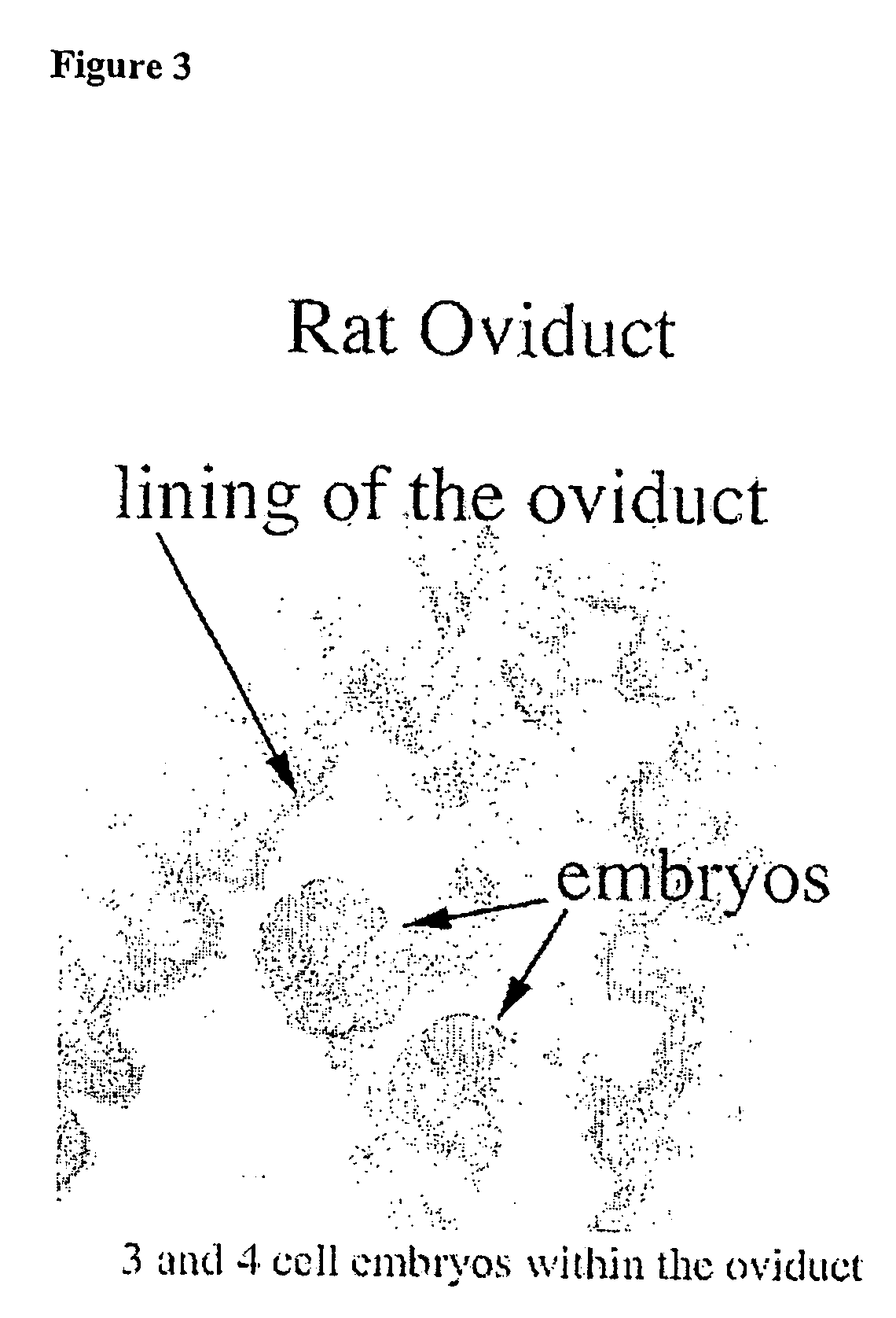 Assay for autoantibodies to folate receptors