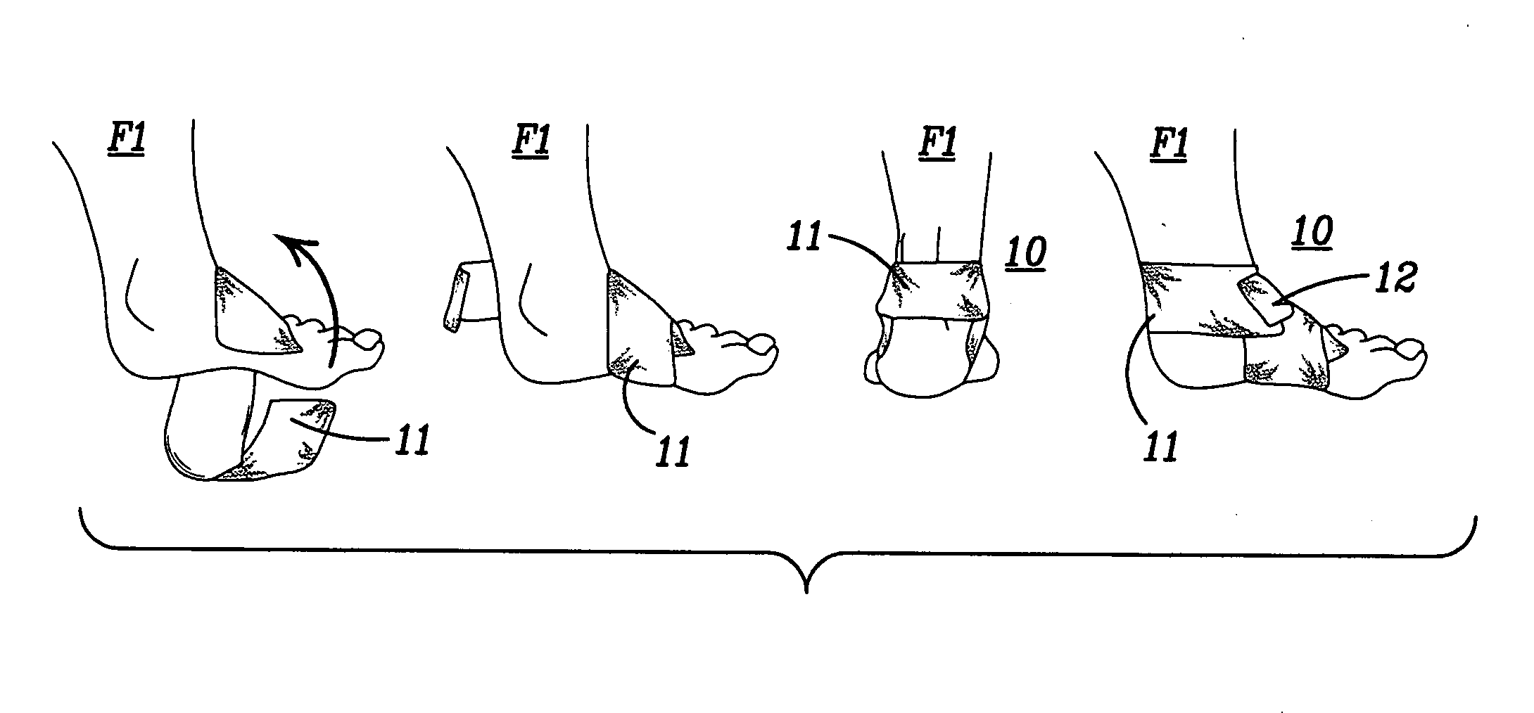 Foot/ankle wrap and method of treating infirmities and abnormalities of the foot and ankle