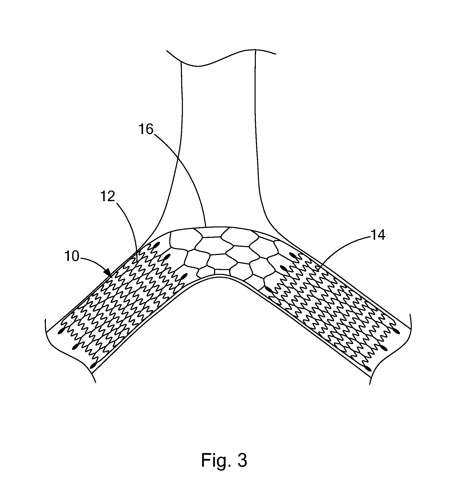 Frame-based vena cava filter