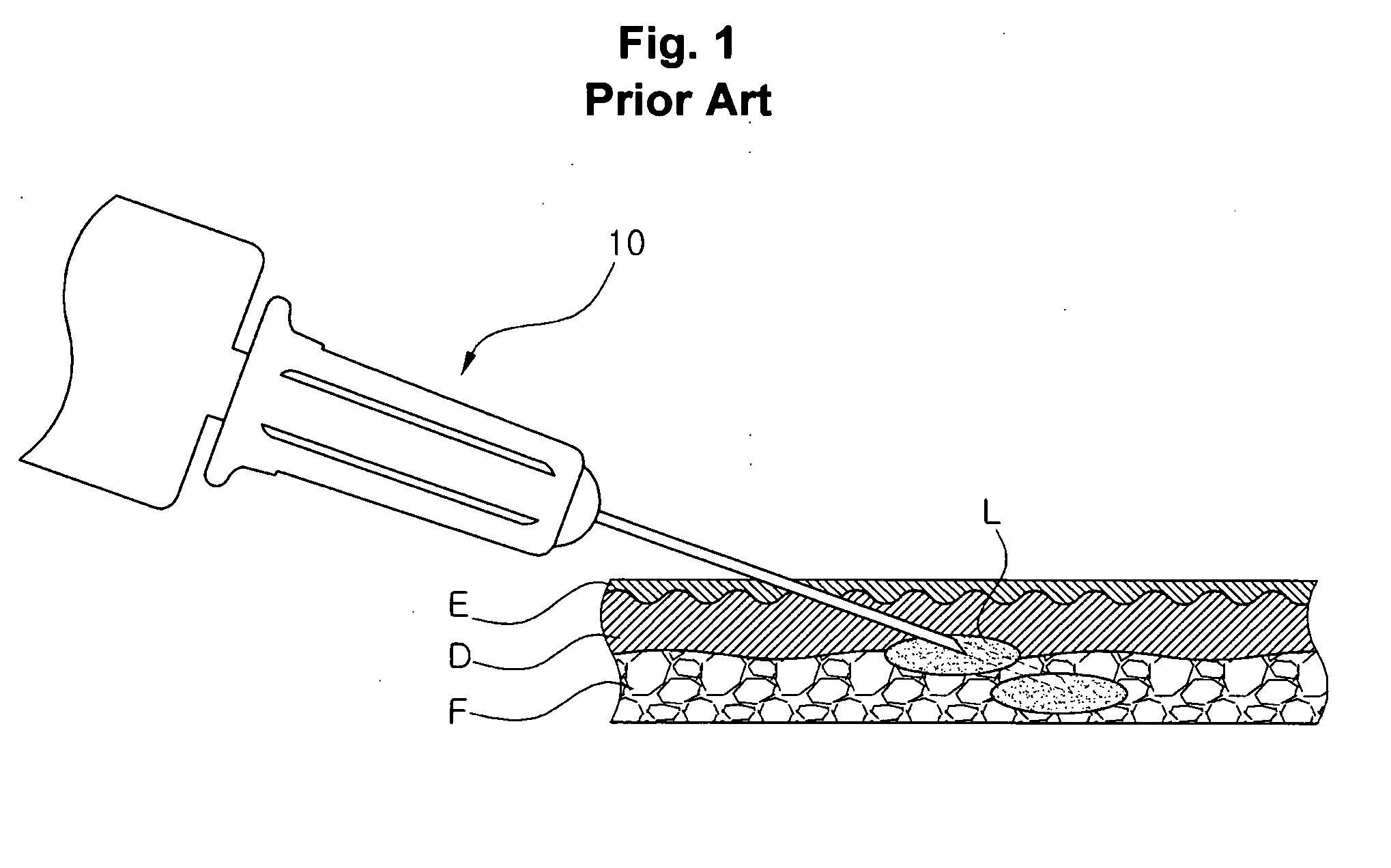 Injection method using injector with length-adjustable needle and injection apparatus using the same