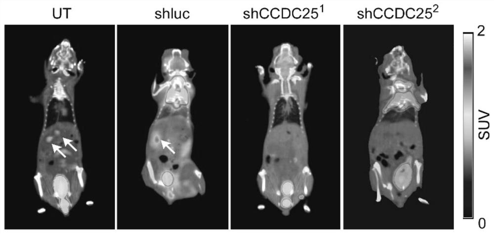 Application of ccdc25 in predicting breast cancer prognosis and inhibiting distant organ metastasis of breast cancer