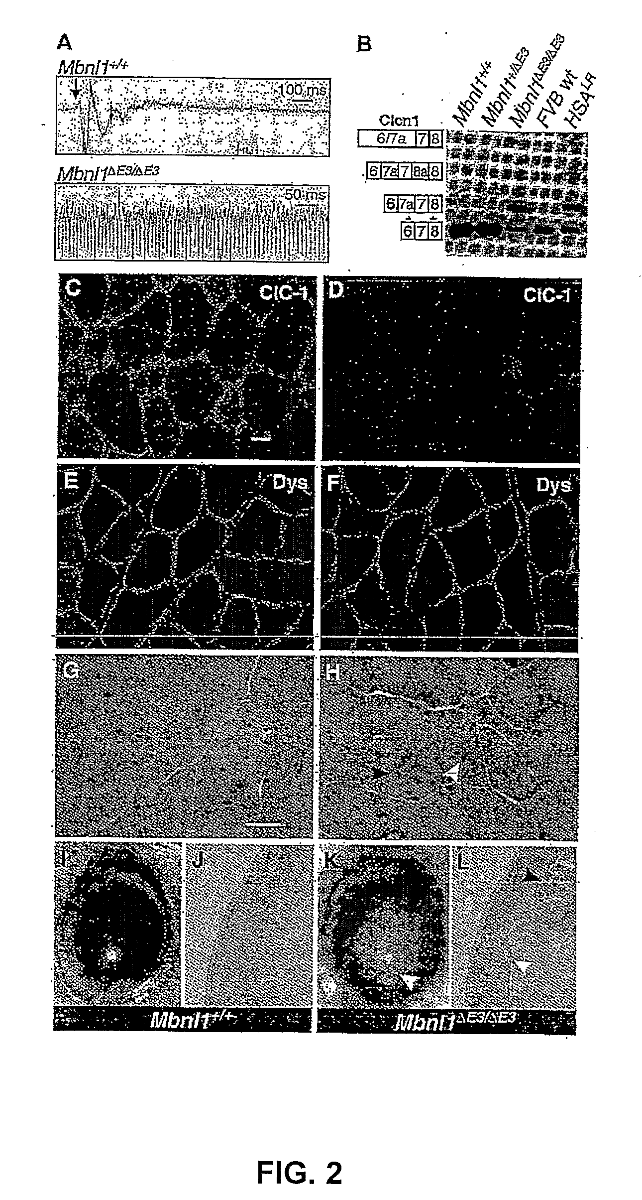 Methods and Compositions for Treatment of Diseases Associated with Aberrant Microsatellite Expansion