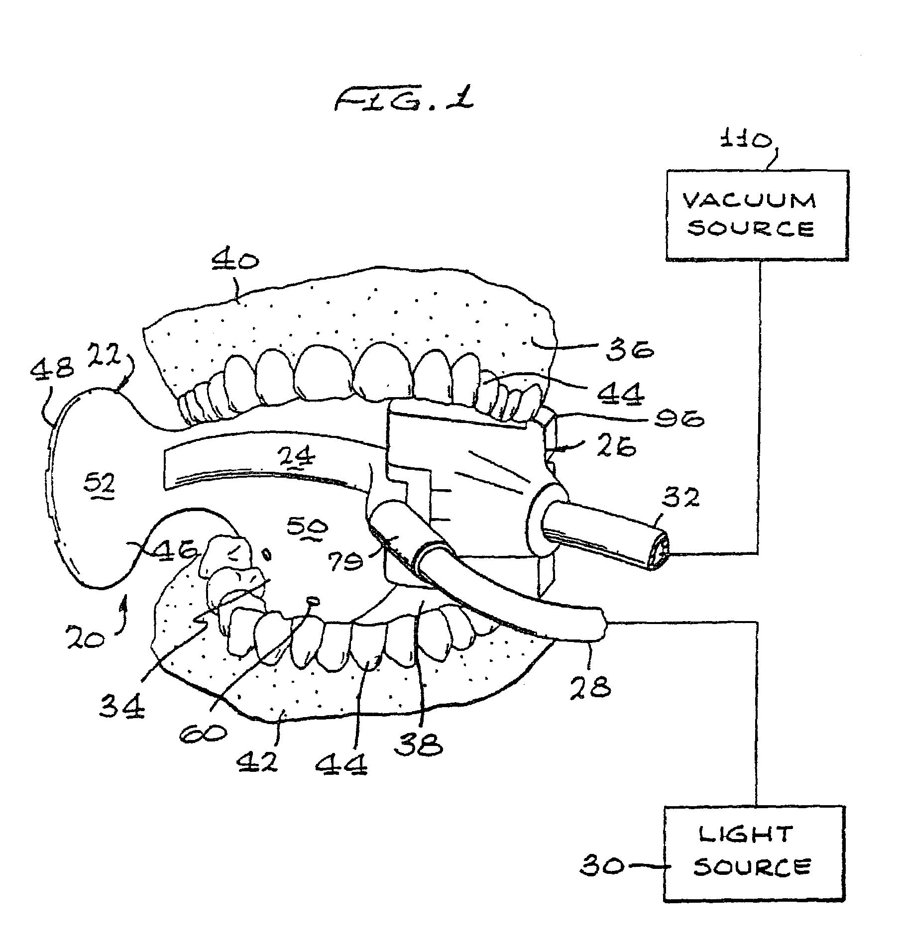 Intraoral device