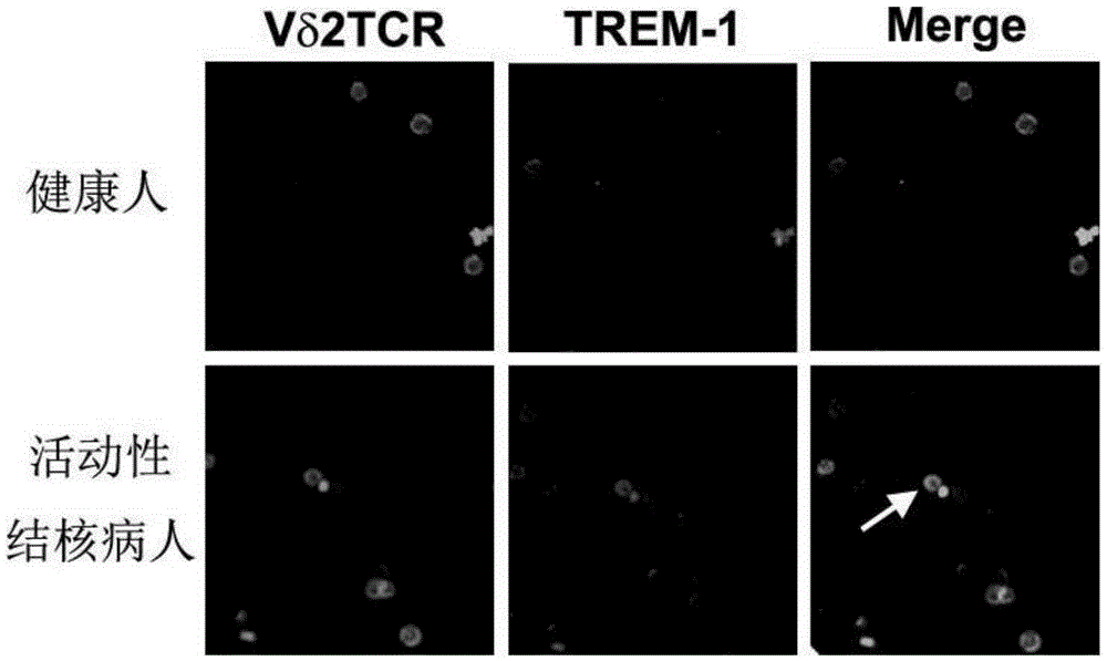 Gamma delta T cell surface activation molecule and kit for quickly diagnosing active tuberculosis