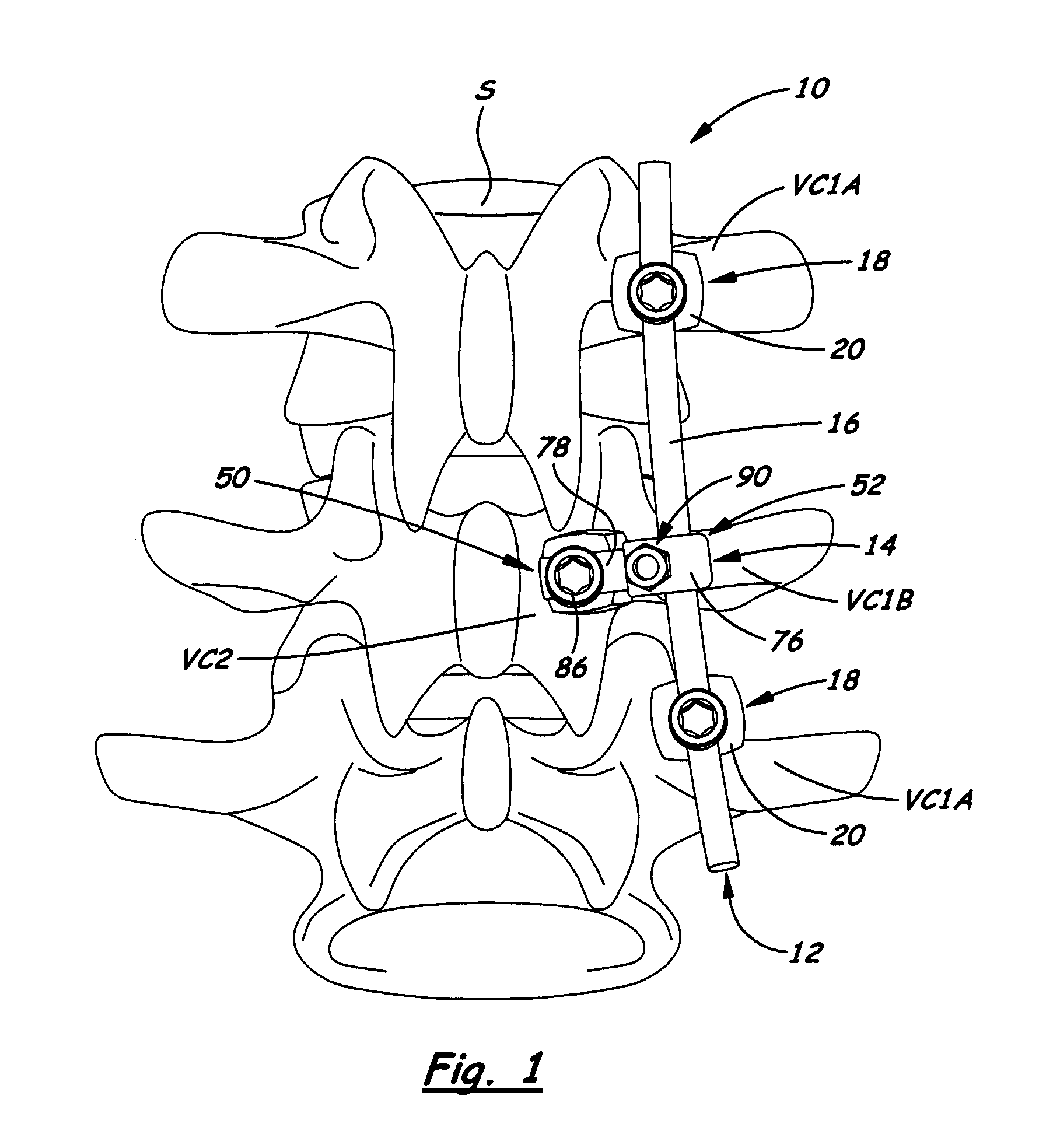 Apparatus for implementing a spinal fixation system with supplemental fixation