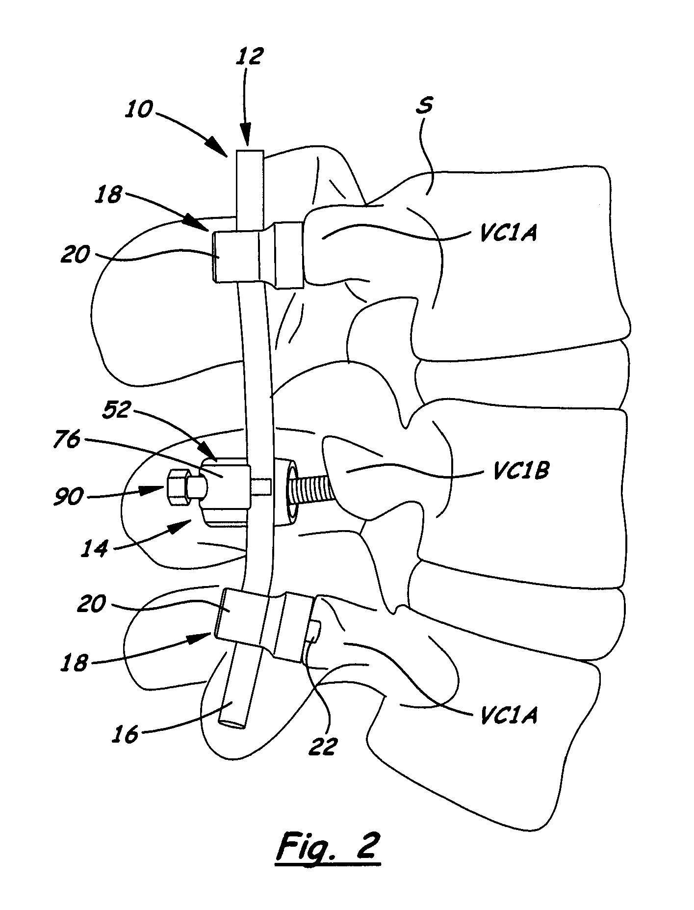 Apparatus for implementing a spinal fixation system with supplemental fixation