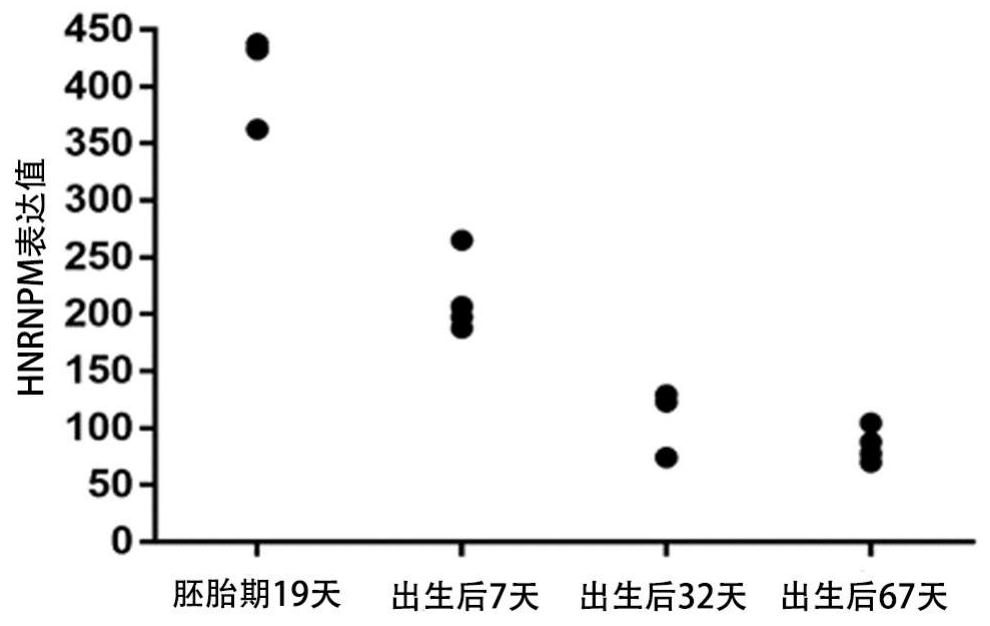 Application of reagent for detecting HNRNPM expression in preparation of medicine composition for diagnosing and/or prognostically judging liver cancer