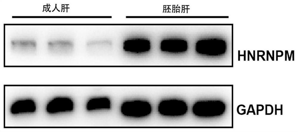 Application of reagent for detecting HNRNPM expression in preparation of medicine composition for diagnosing and/or prognostically judging liver cancer