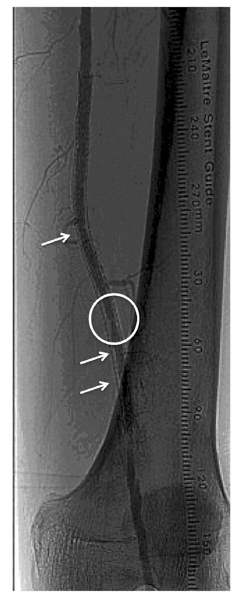 Apparatus and method for treatment of in-stent restenosis