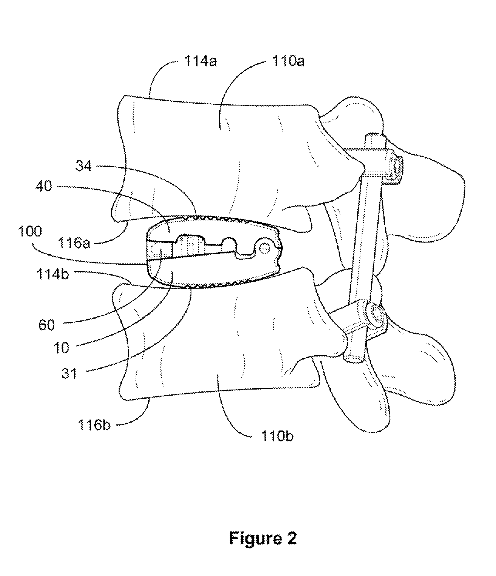 Bone Cage with Components for Controlled Expansion