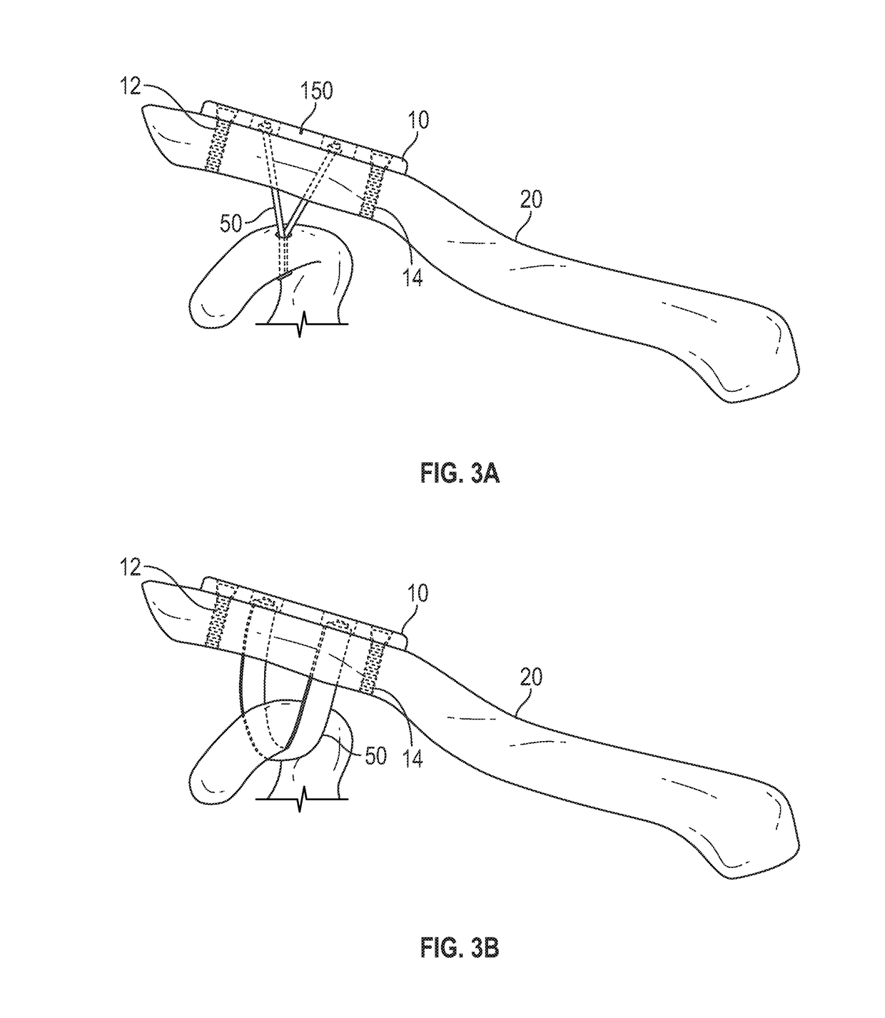 Device for and method of treating acromioclavicular joint dislocations