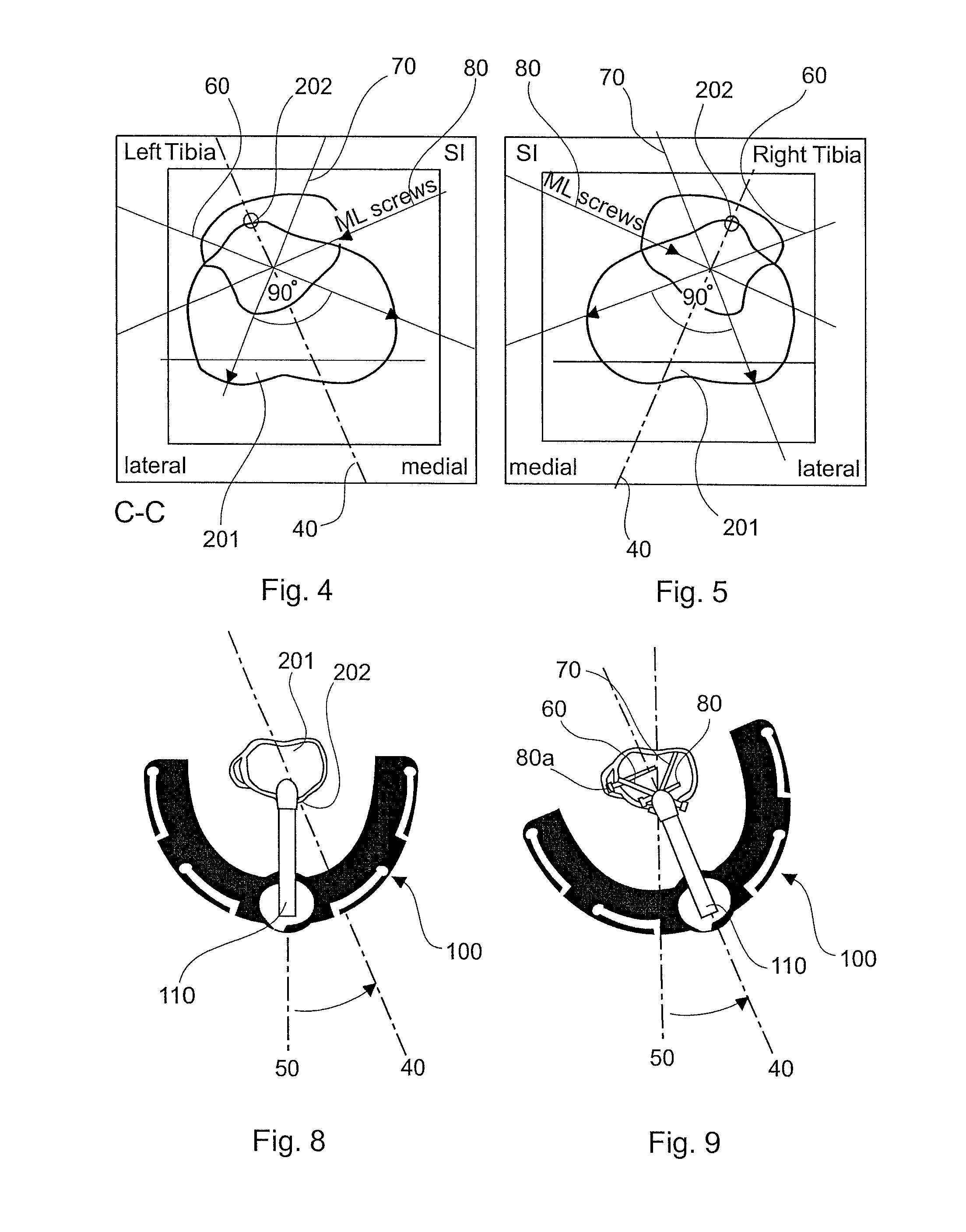 Method for tibial nail insertion