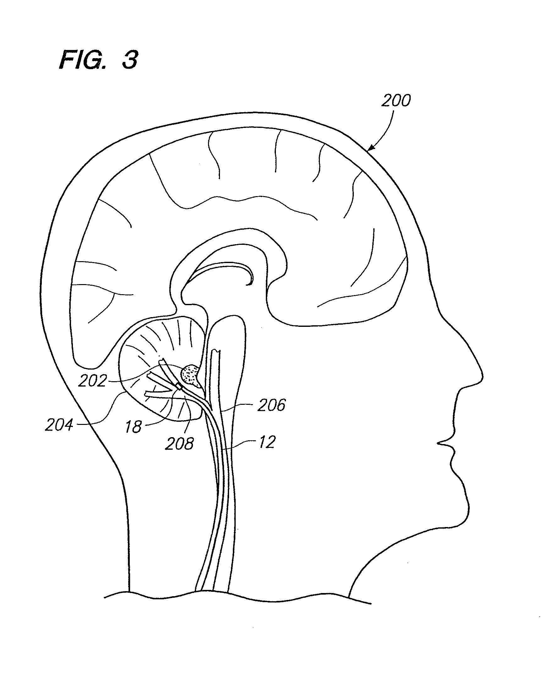 Method of stimulating fastigium nucleus to treat neurological disorders