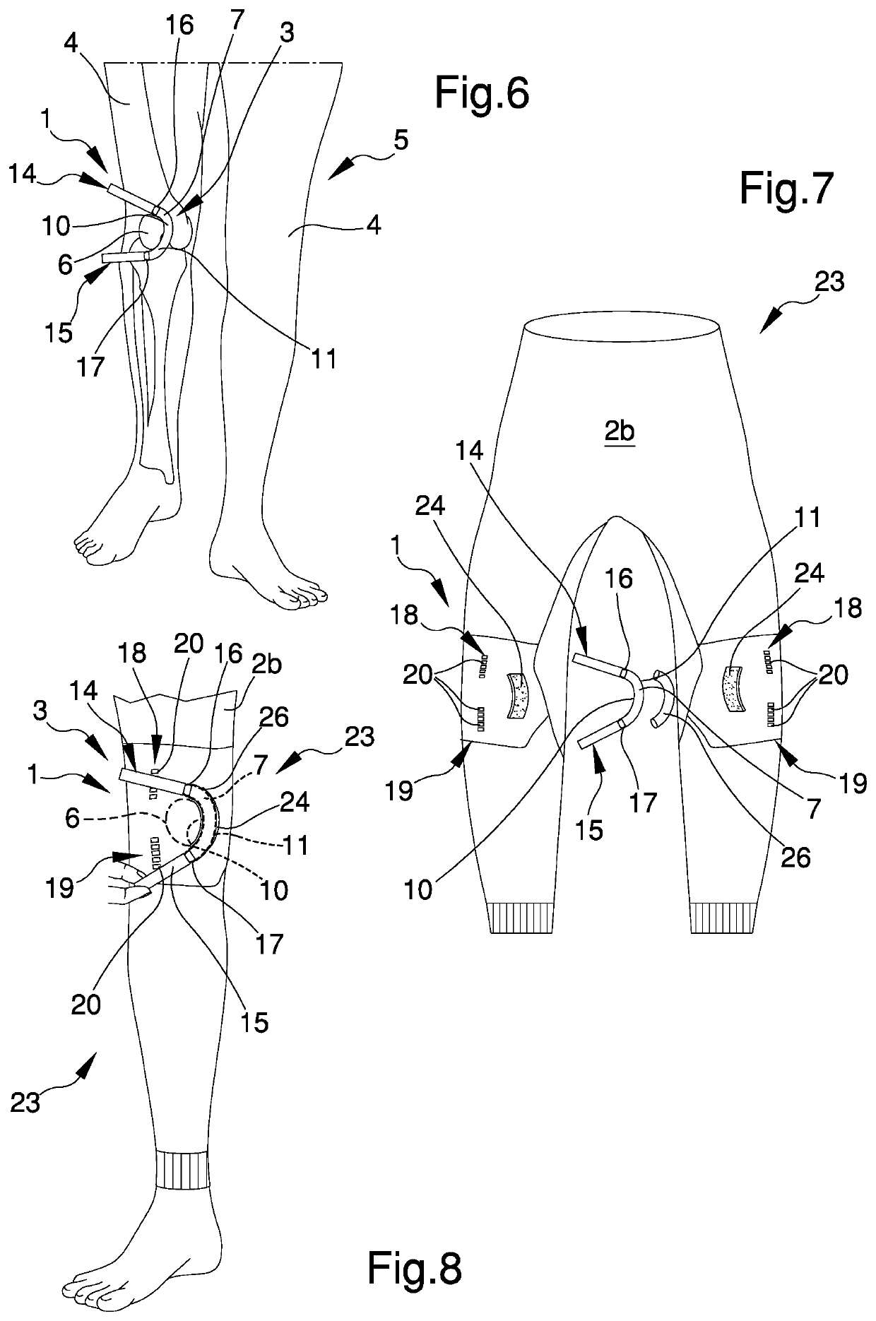 Joint stabilization device, particularly for the patellofemoral joint