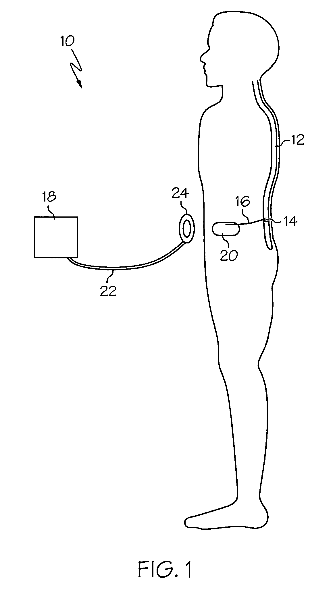 Electrical tissue stimulation apparatus and method