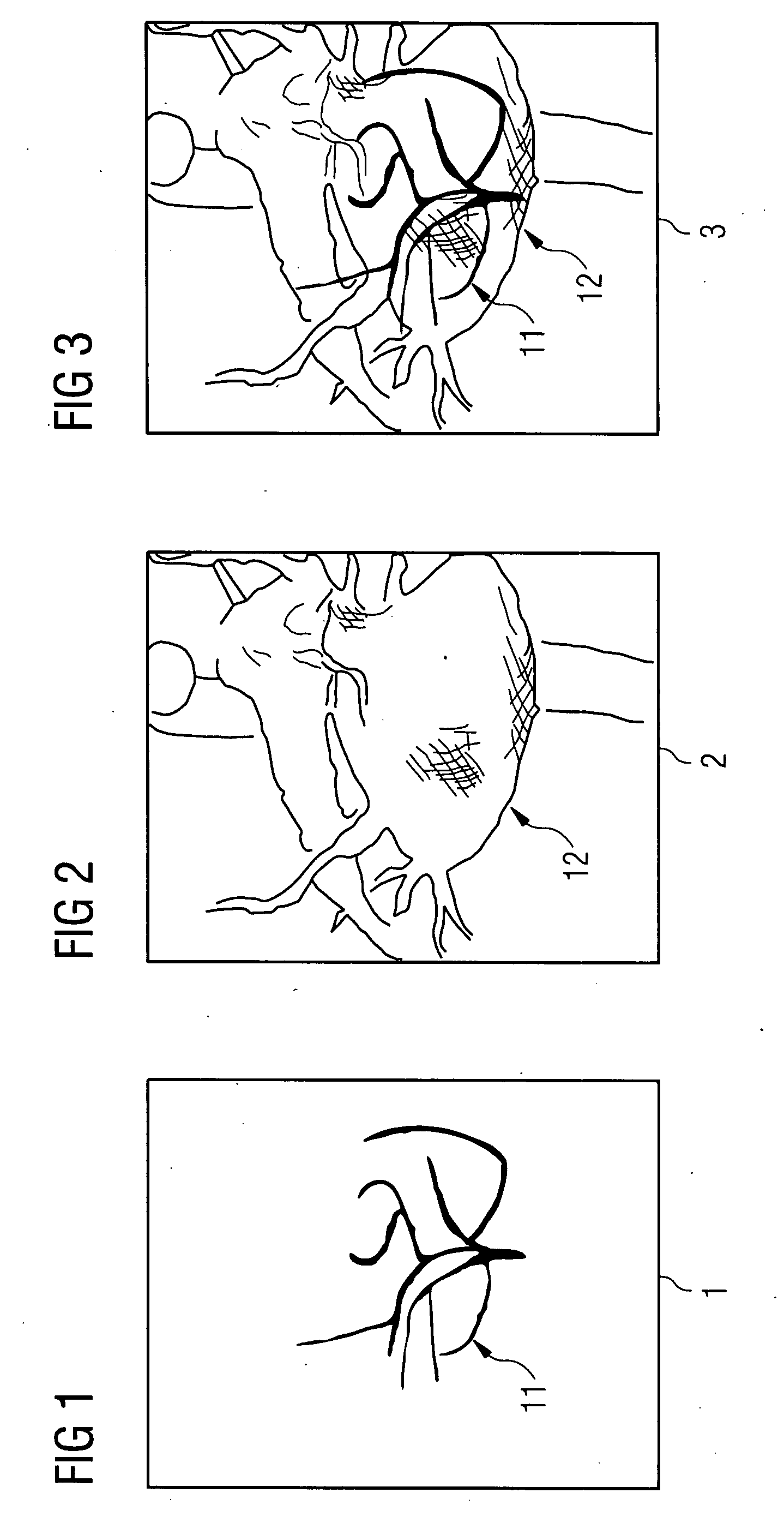 Method and device for the combined representation of 2D fluoroscopic images and a static 3D image data set