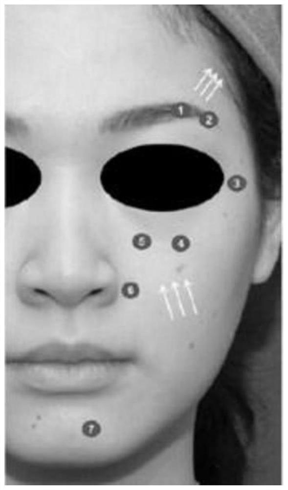 Face multi-point injection medical cosmetology method