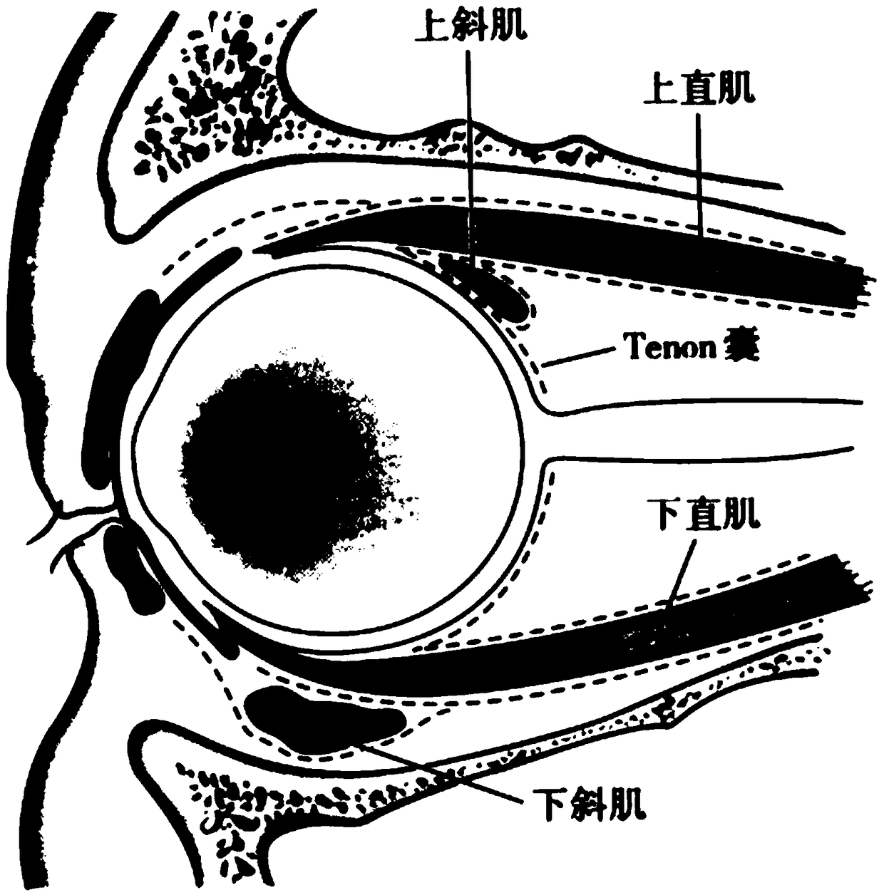 tenon subcapsular drug injection device