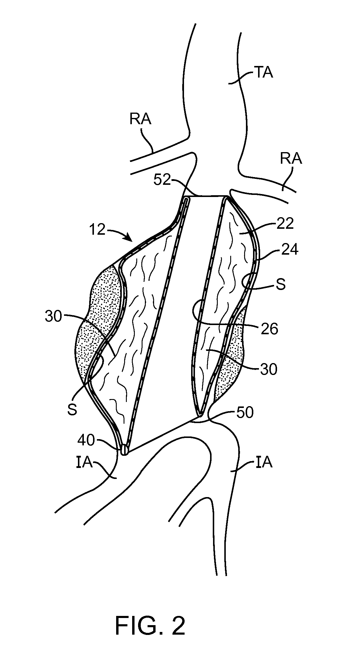 Graft Systems Having Semi-Permeable Filling Structures and Methods for Their Use