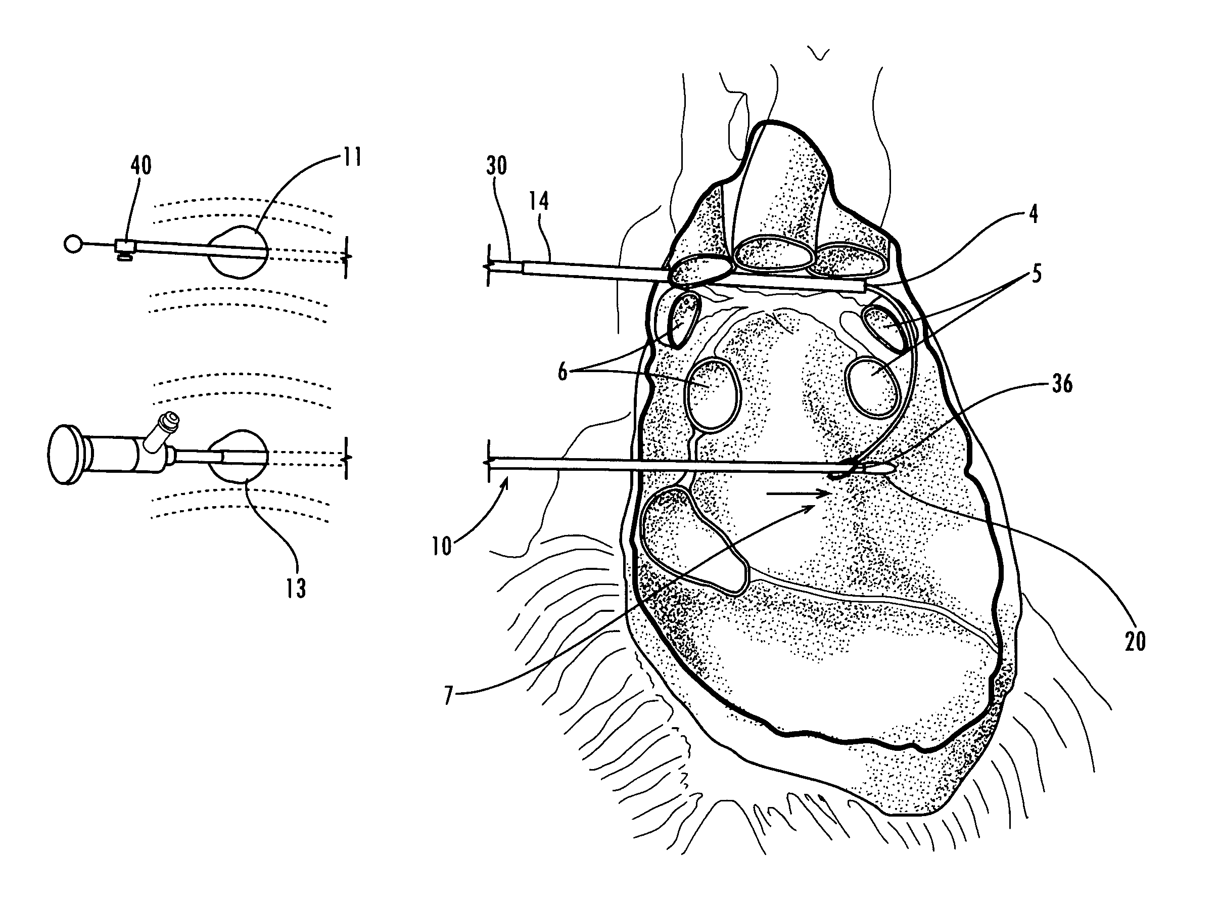 Apparatus and methods for performing ablation