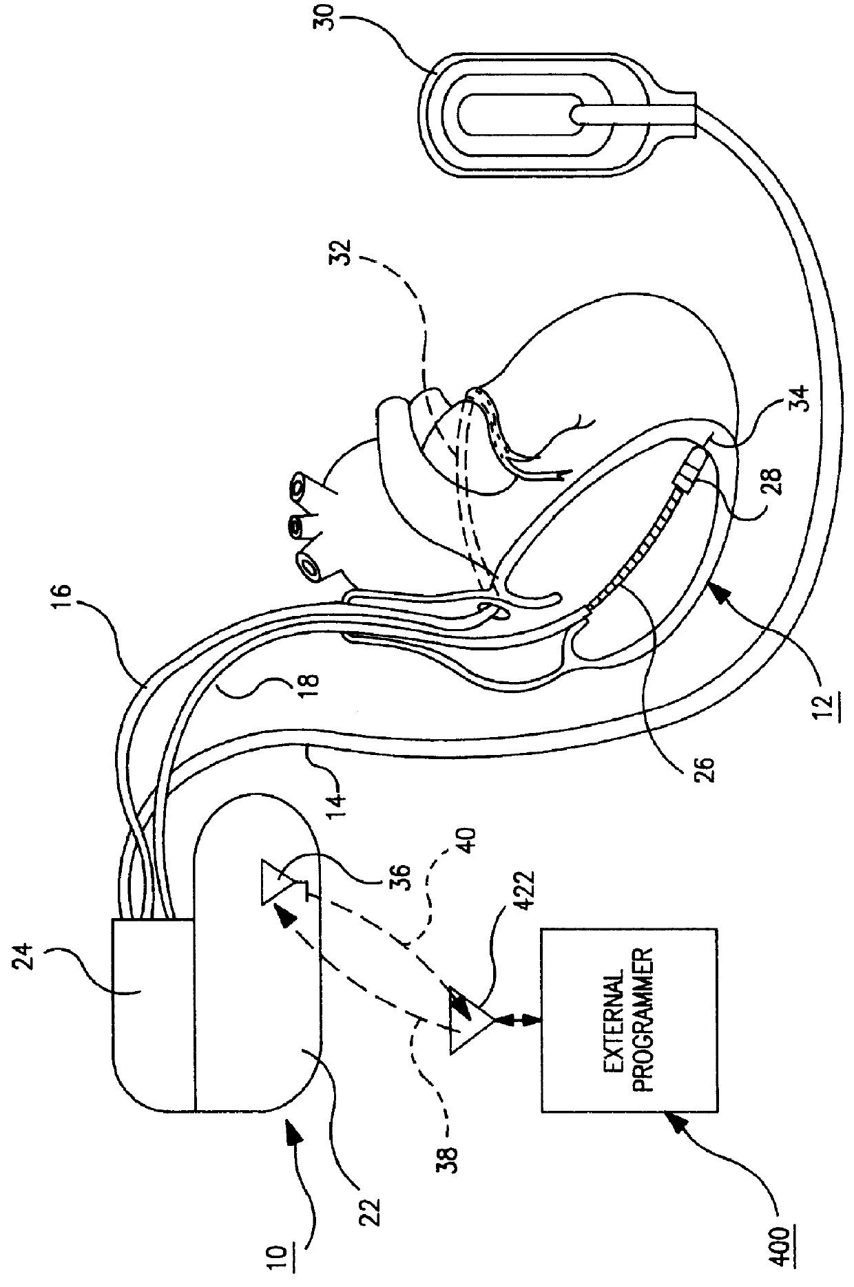 Error code calculations for data stored in an implantable medical device